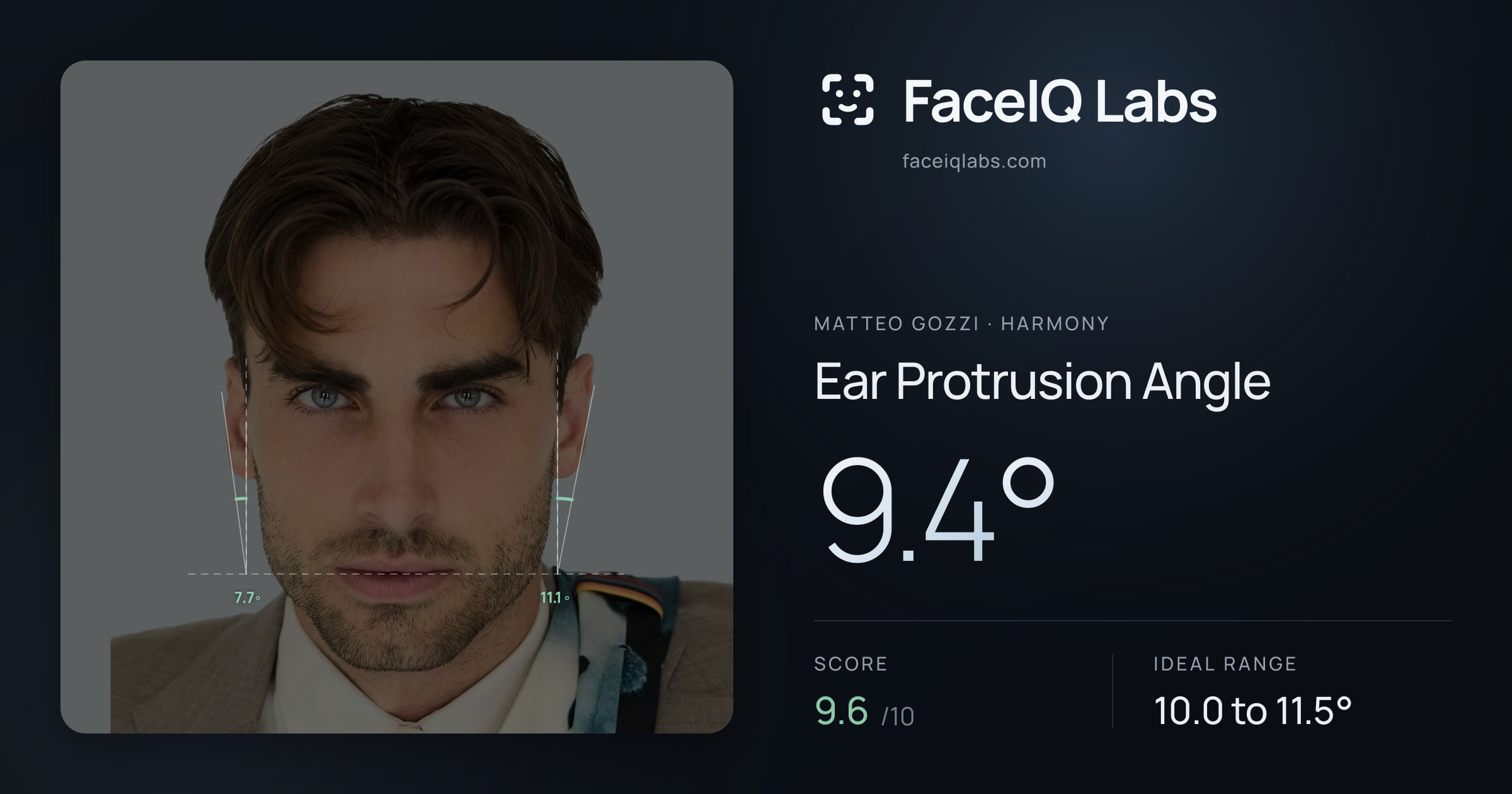Matteo Gozzi Ear Protrusion Angle: 9.4°, drawn on the photo