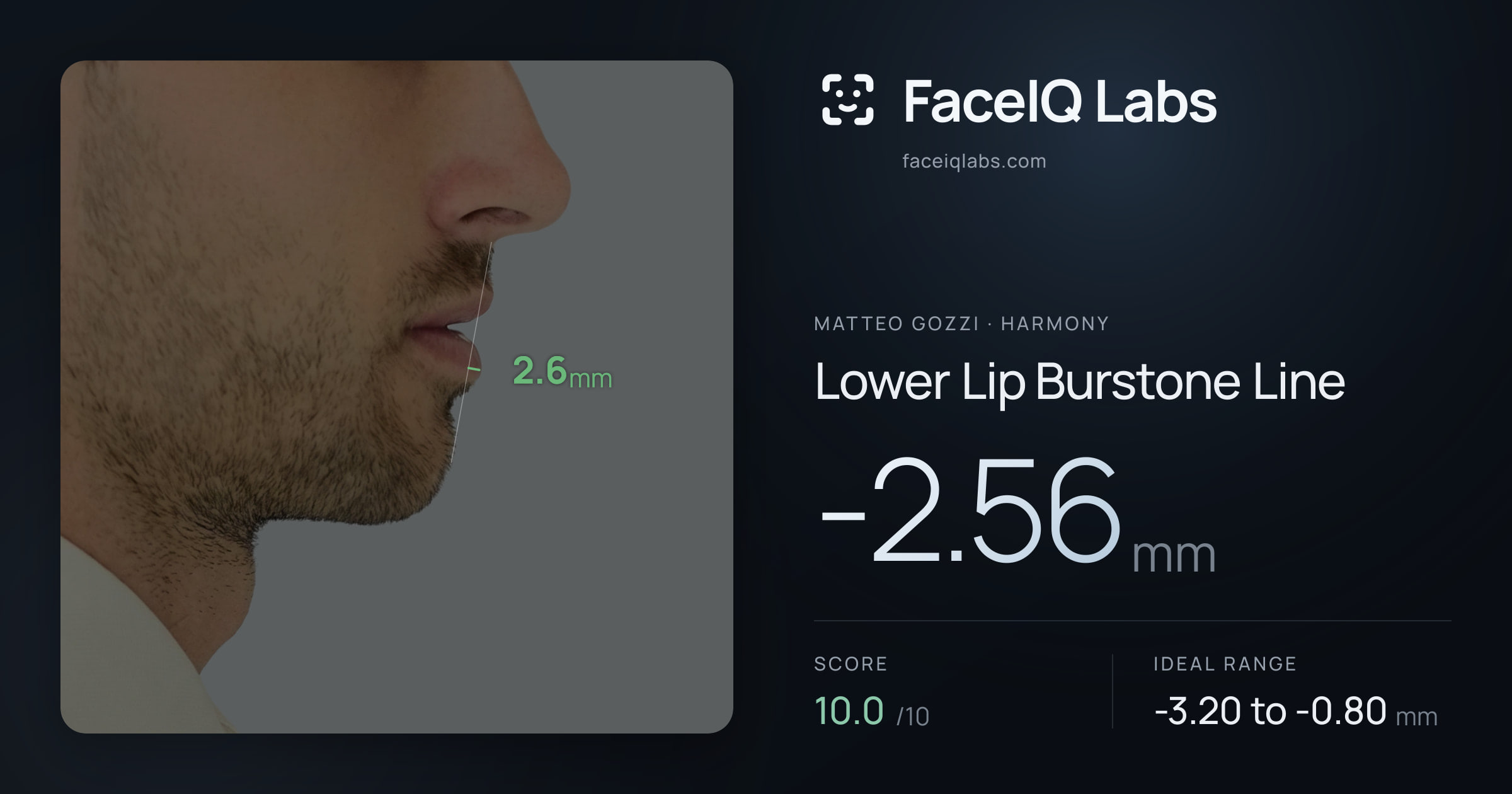 Matteo Gozzi Lower Lip Burstone Line: -2.56mm, drawn on the photo