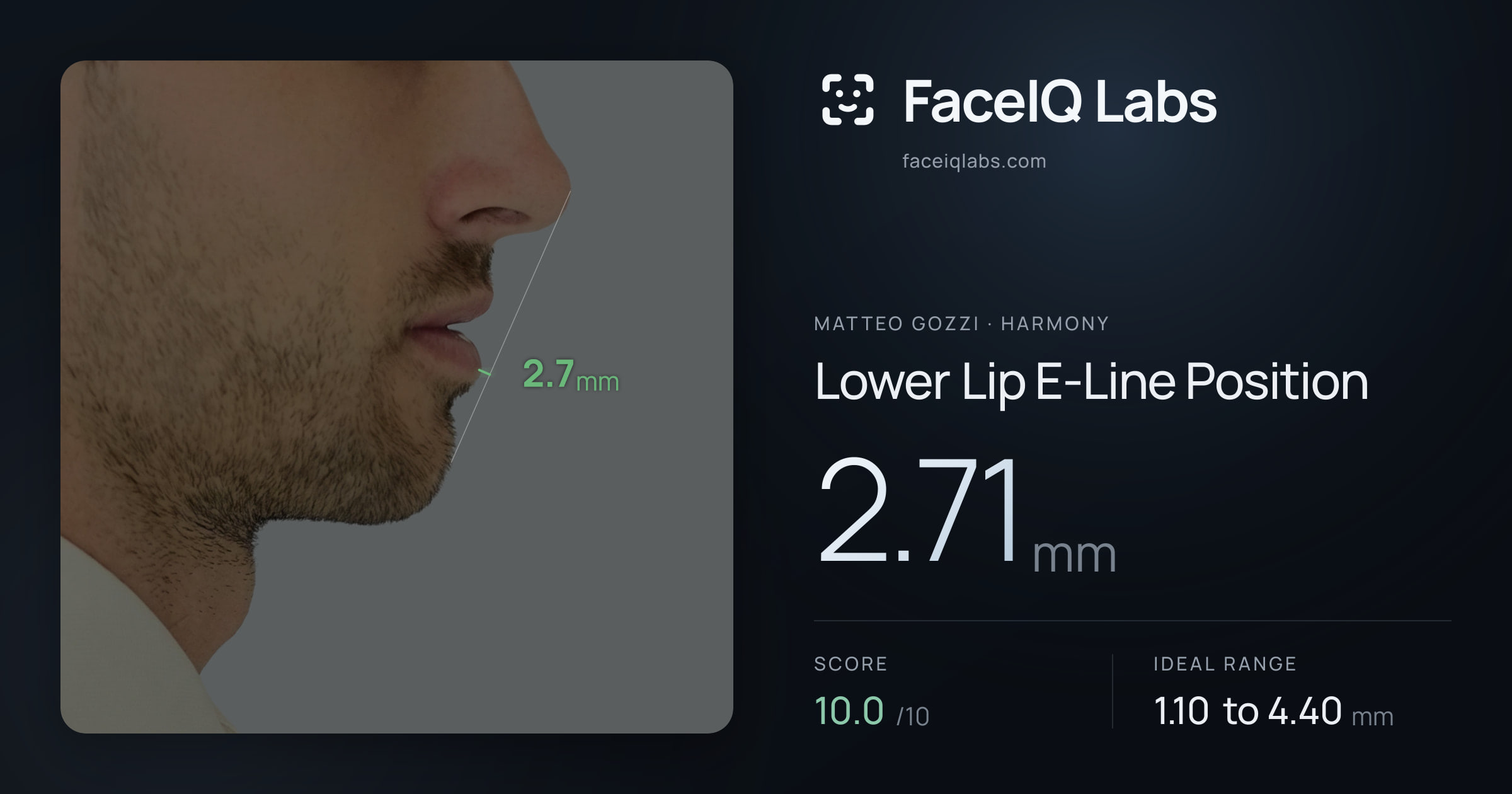 Matteo Gozzi Lower Lip E-Line Position: 2.71mm, drawn on the photo