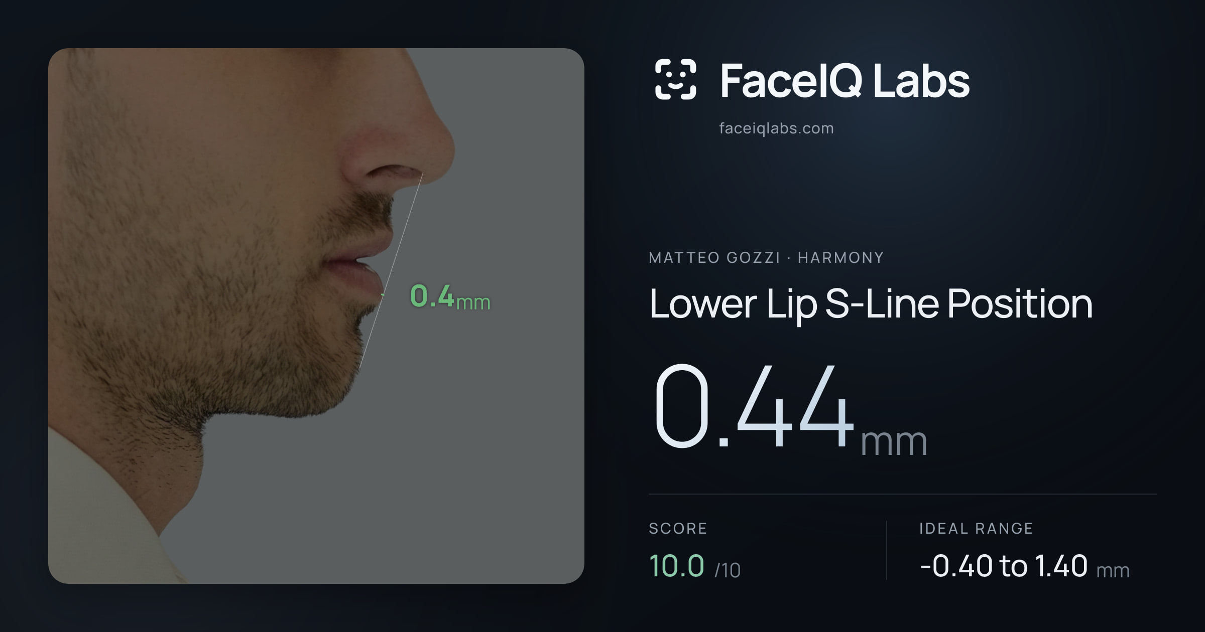 Matteo Gozzi Lower Lip S-Line Position: 0.44mm, drawn on the photo
