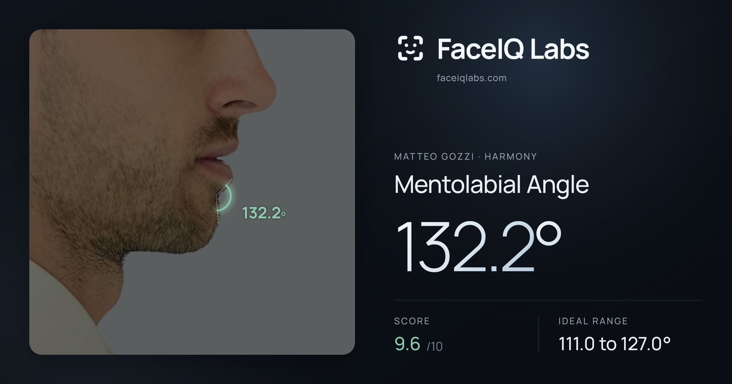 Matteo Gozzi Mentolabial Angle: 132.2°, drawn on the photo