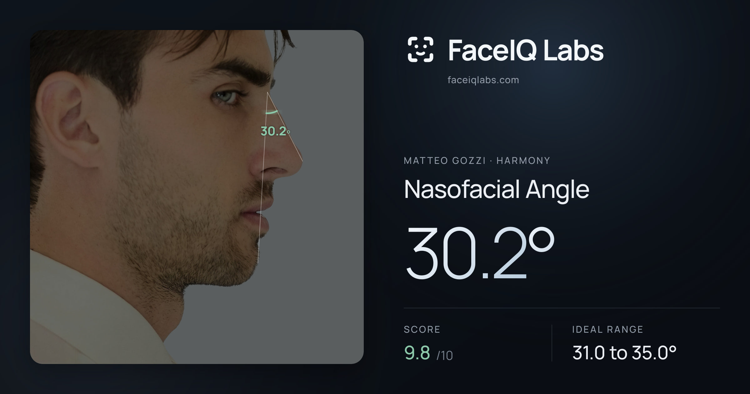 Matteo Gozzi Nasofacial Angle: 30.2°, drawn on the photo