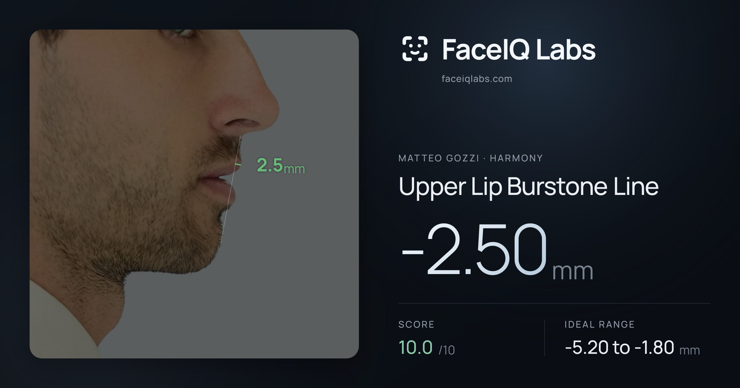 Matteo Gozzi Upper Lip Burstone Line: -2.50mm, drawn on the photo