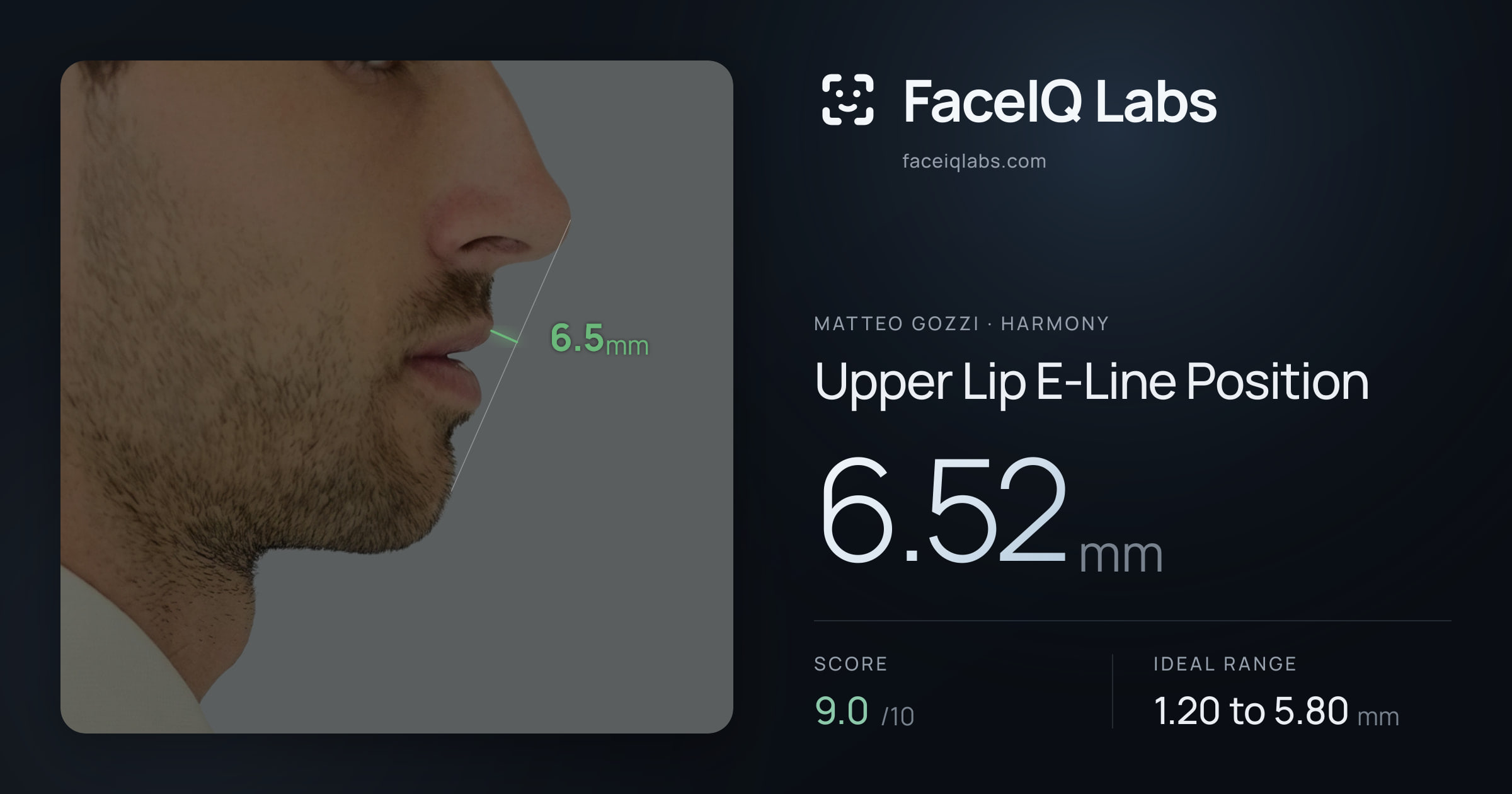 Matteo Gozzi Upper Lip E-Line Position: 6.52mm, drawn on the photo