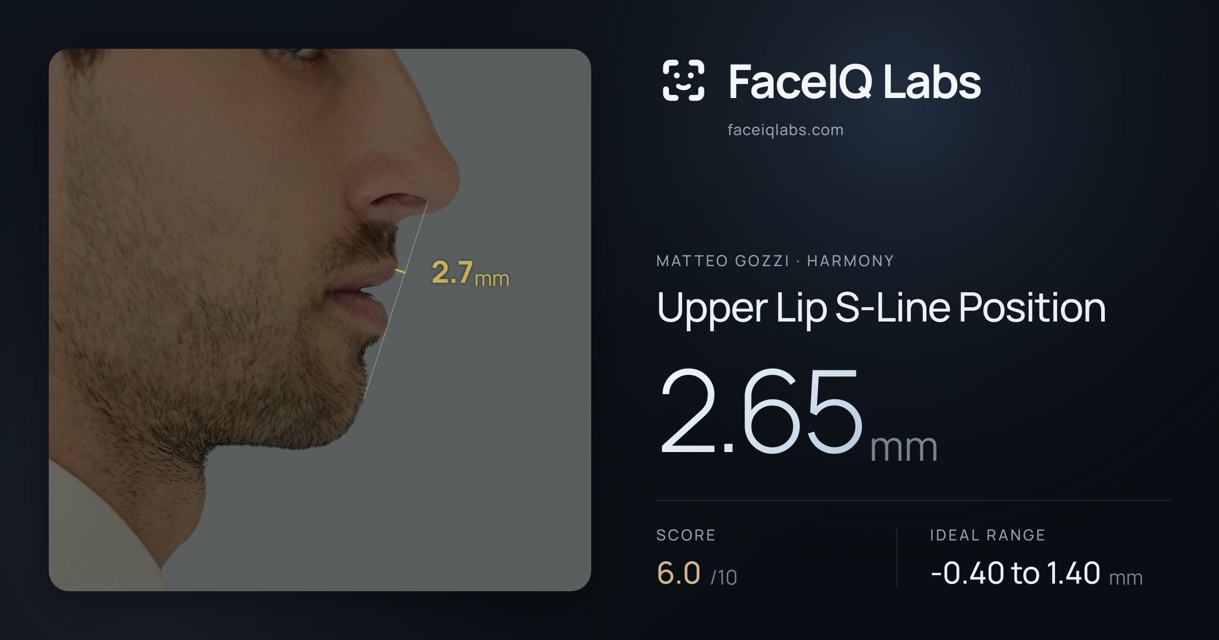 Matteo Gozzi Upper Lip S-Line Position: 2.65mm, drawn on the photo