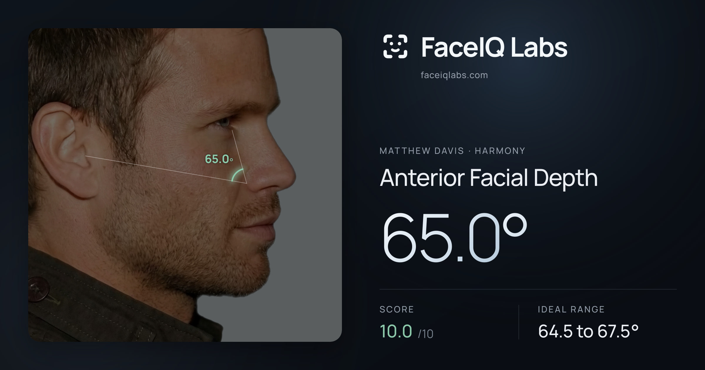 Matthew Davis Anterior Facial Depth: 65.0°, drawn on the photo