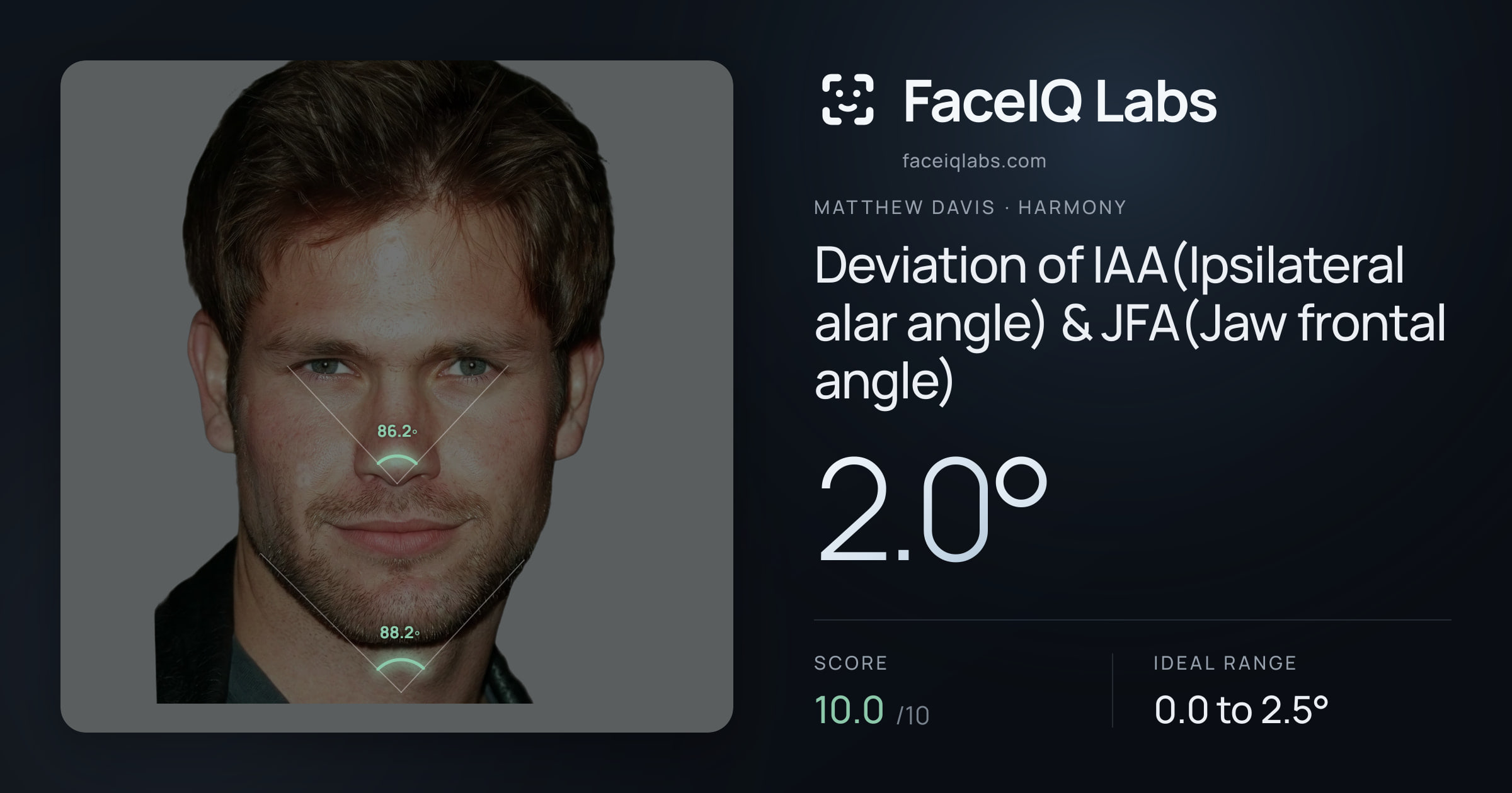 Matthew Davis Deviation of IAA(Ipsilateral alar angle) & JFA(Jaw frontal angle): 2.0°, drawn on the photo