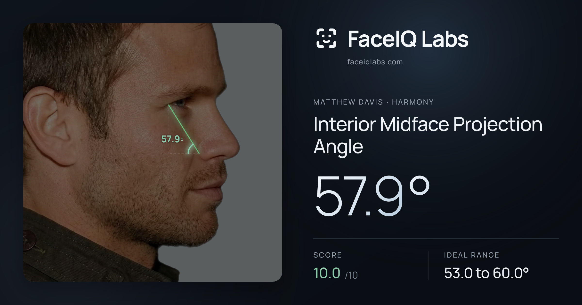 Matthew Davis Interior Midface Projection Angle: 57.9°, drawn on the photo