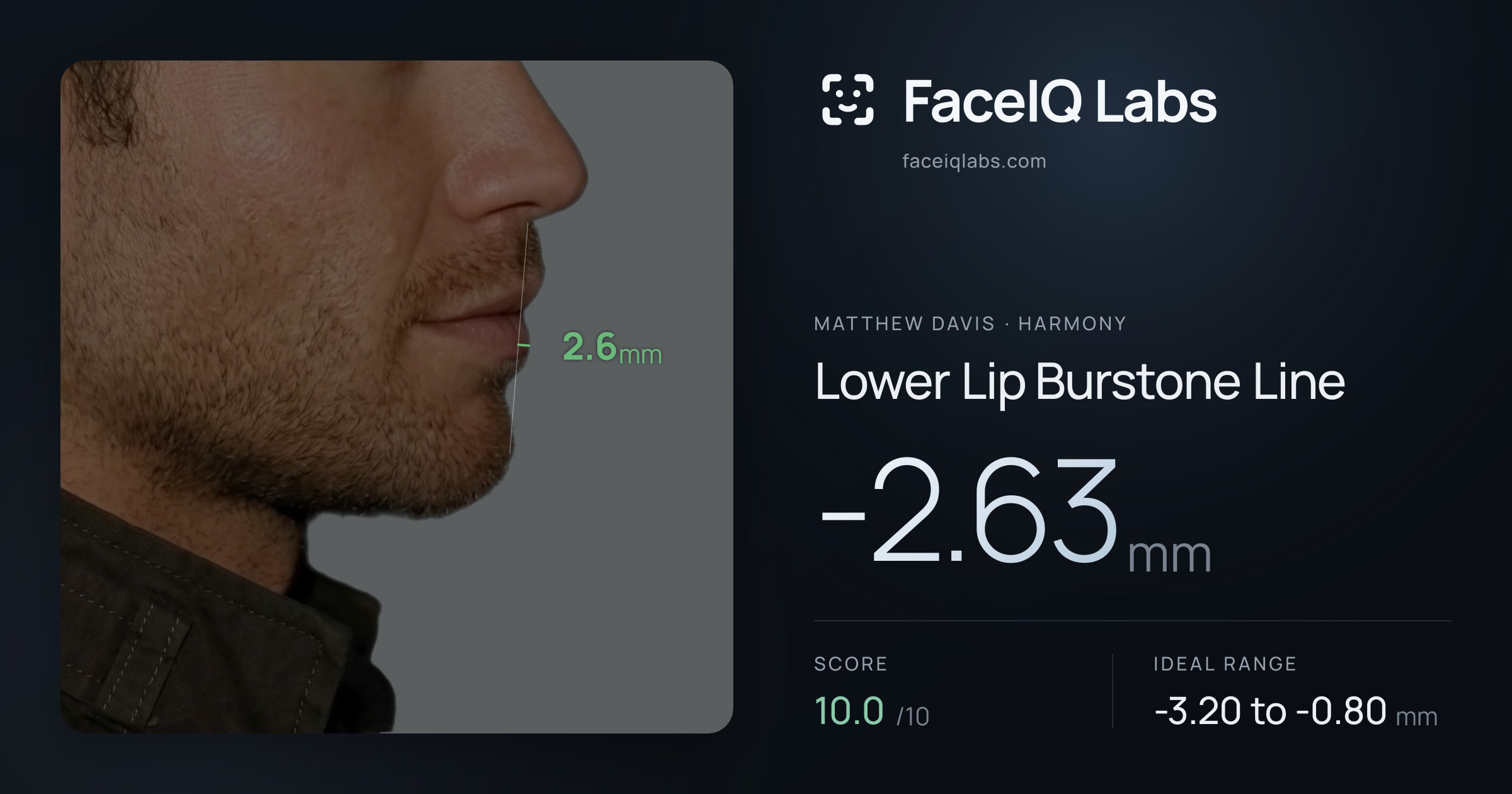 Matthew Davis Lower Lip Burstone Line: -2.63mm, drawn on the photo