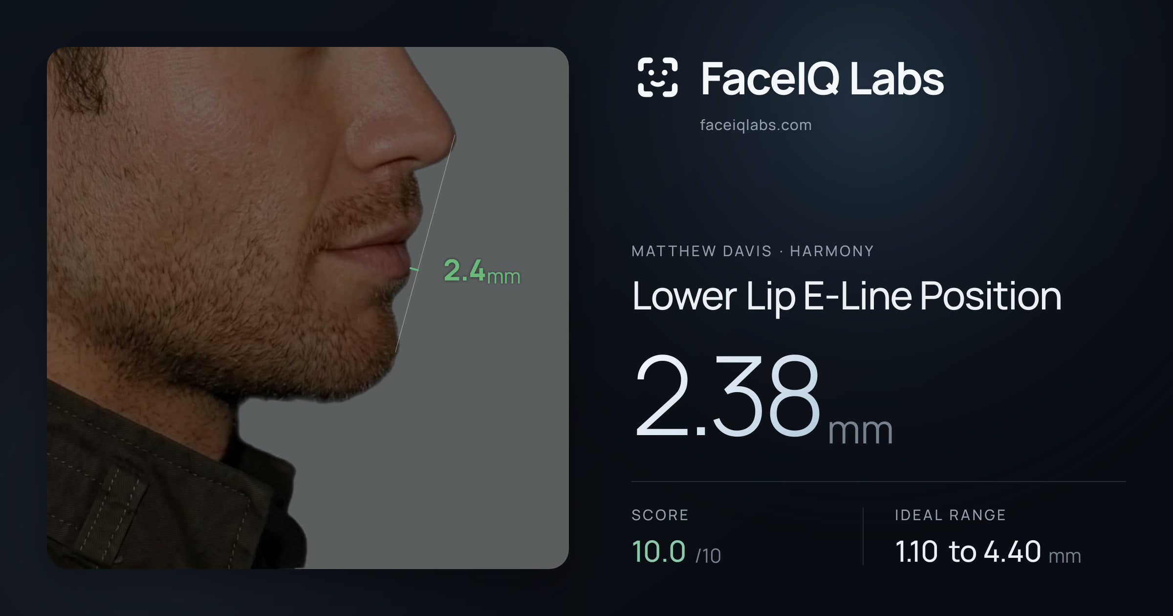 Matthew Davis Lower Lip E-Line Position: 2.38mm, drawn on the photo