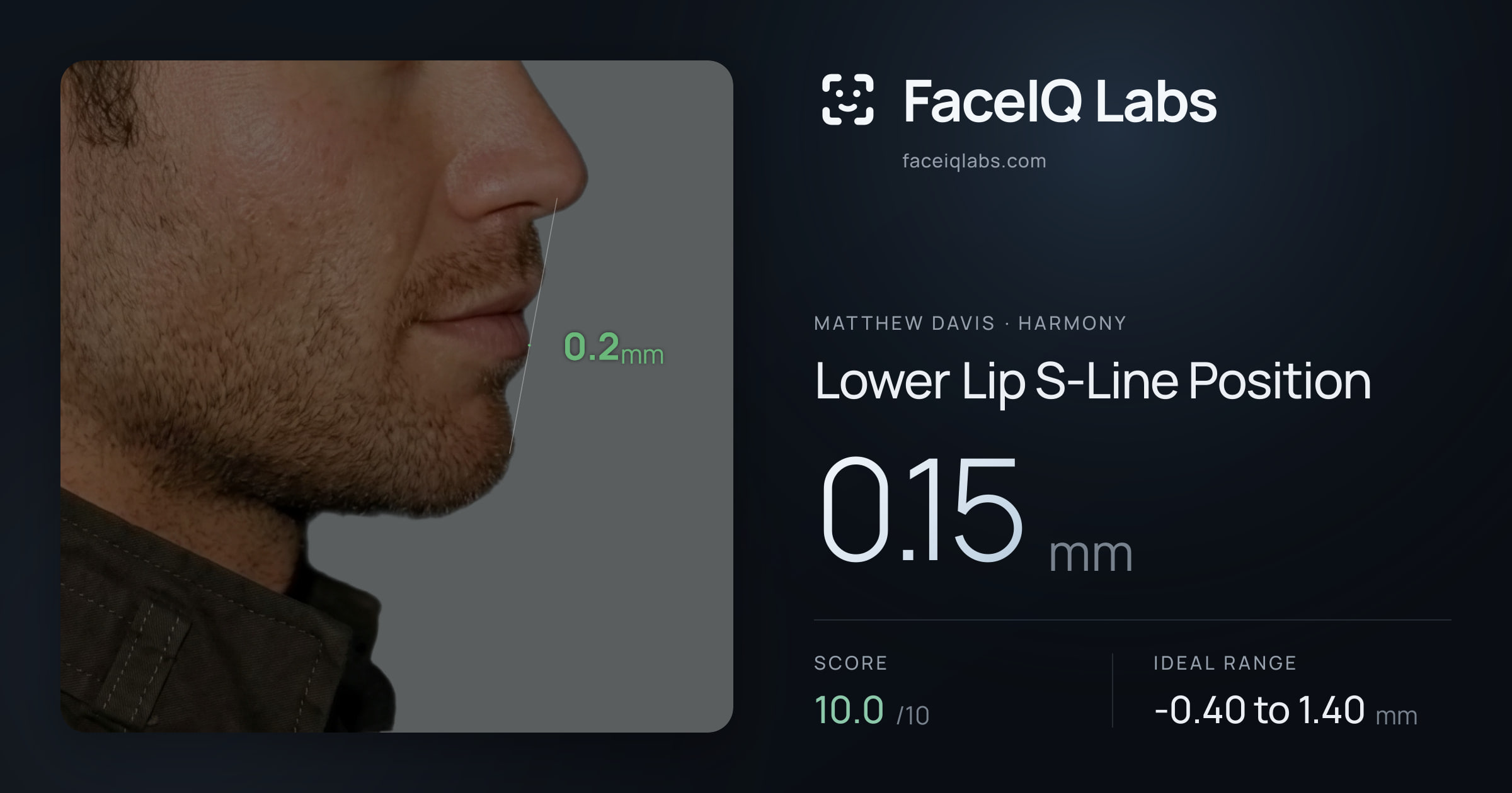 Matthew Davis Lower Lip S-Line Position: 0.15mm, drawn on the photo
