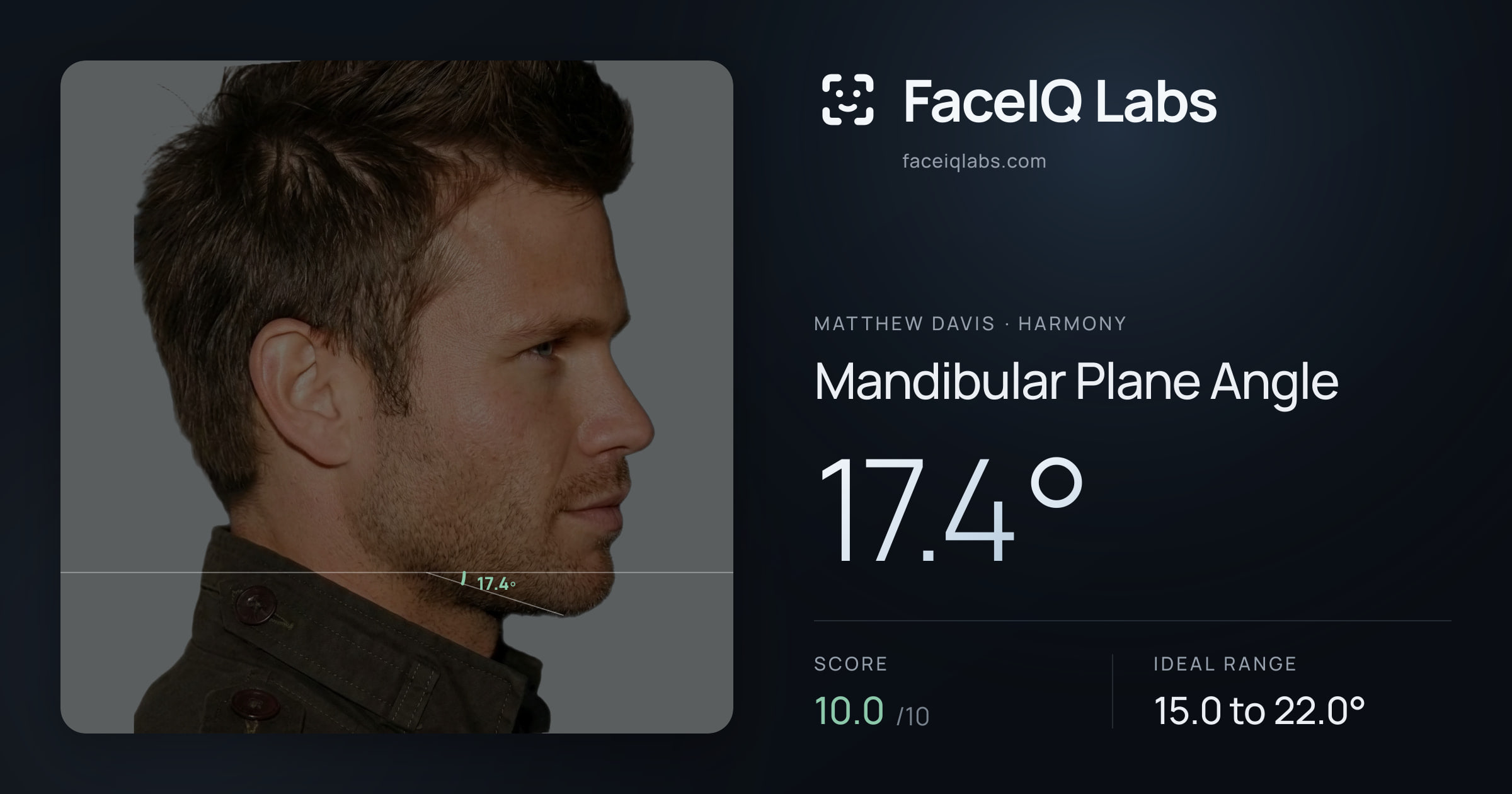 Matthew Davis Mandibular Plane Angle: 17.4°, drawn on the photo