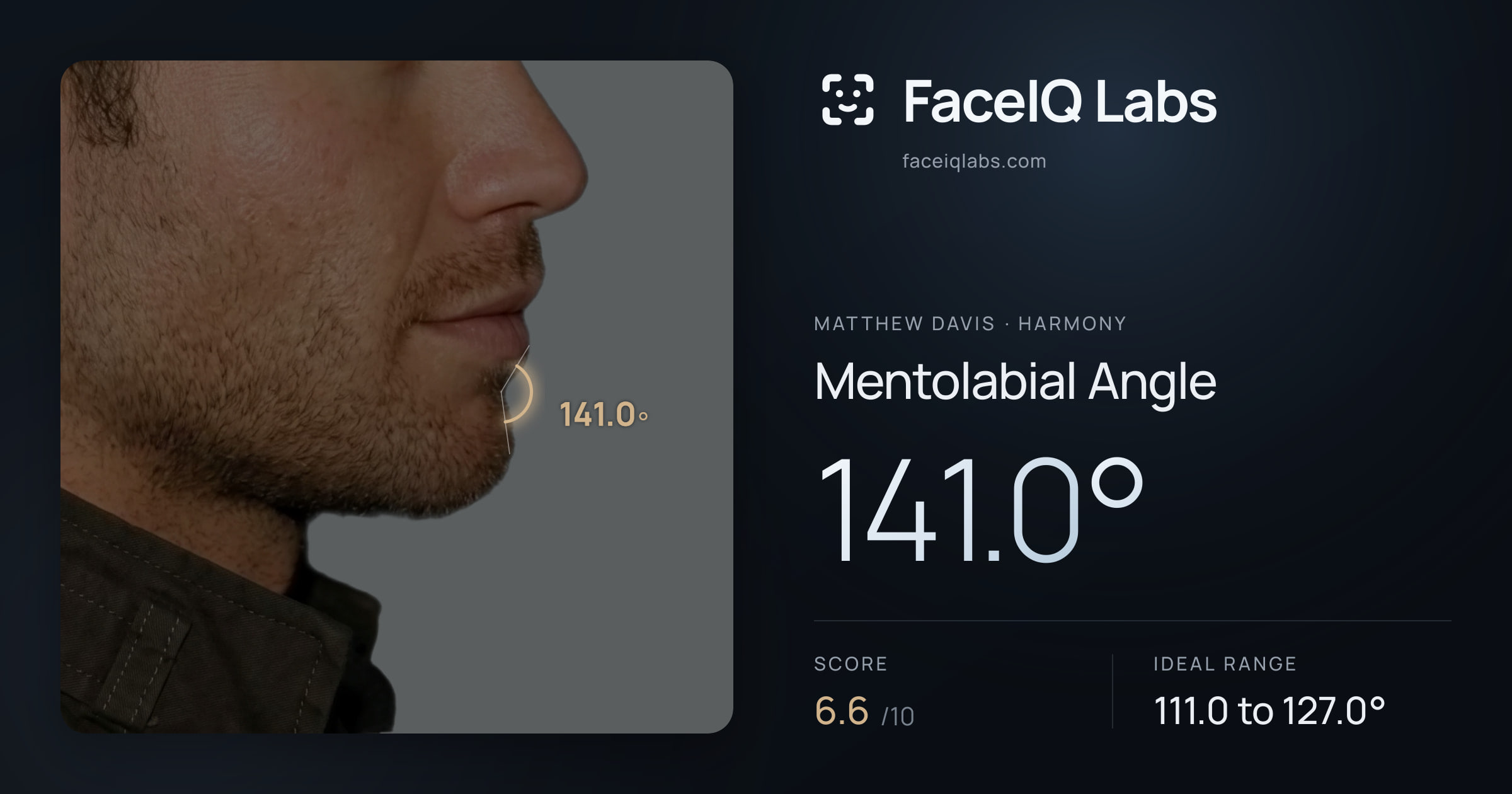 Matthew Davis Mentolabial Angle: 141.0°, drawn on the photo