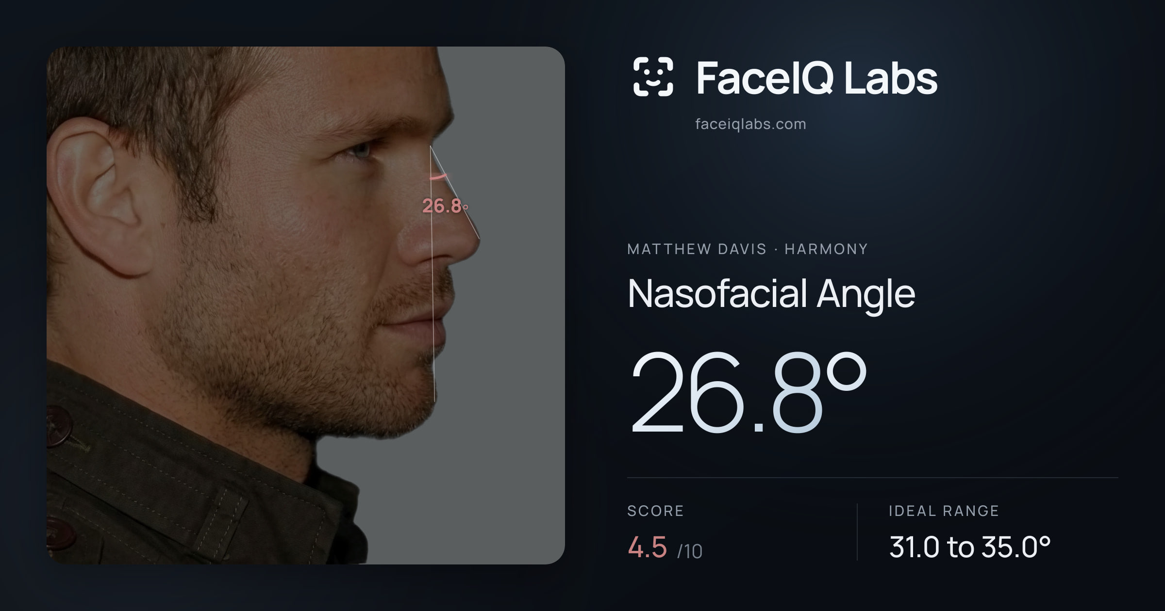 Matthew Davis Nasofacial Angle: 26.8°, drawn on the photo