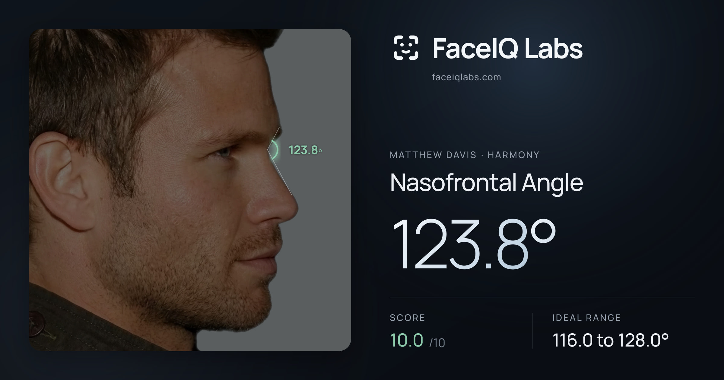 Matthew Davis Nasofrontal Angle: 123.8°, drawn on the photo
