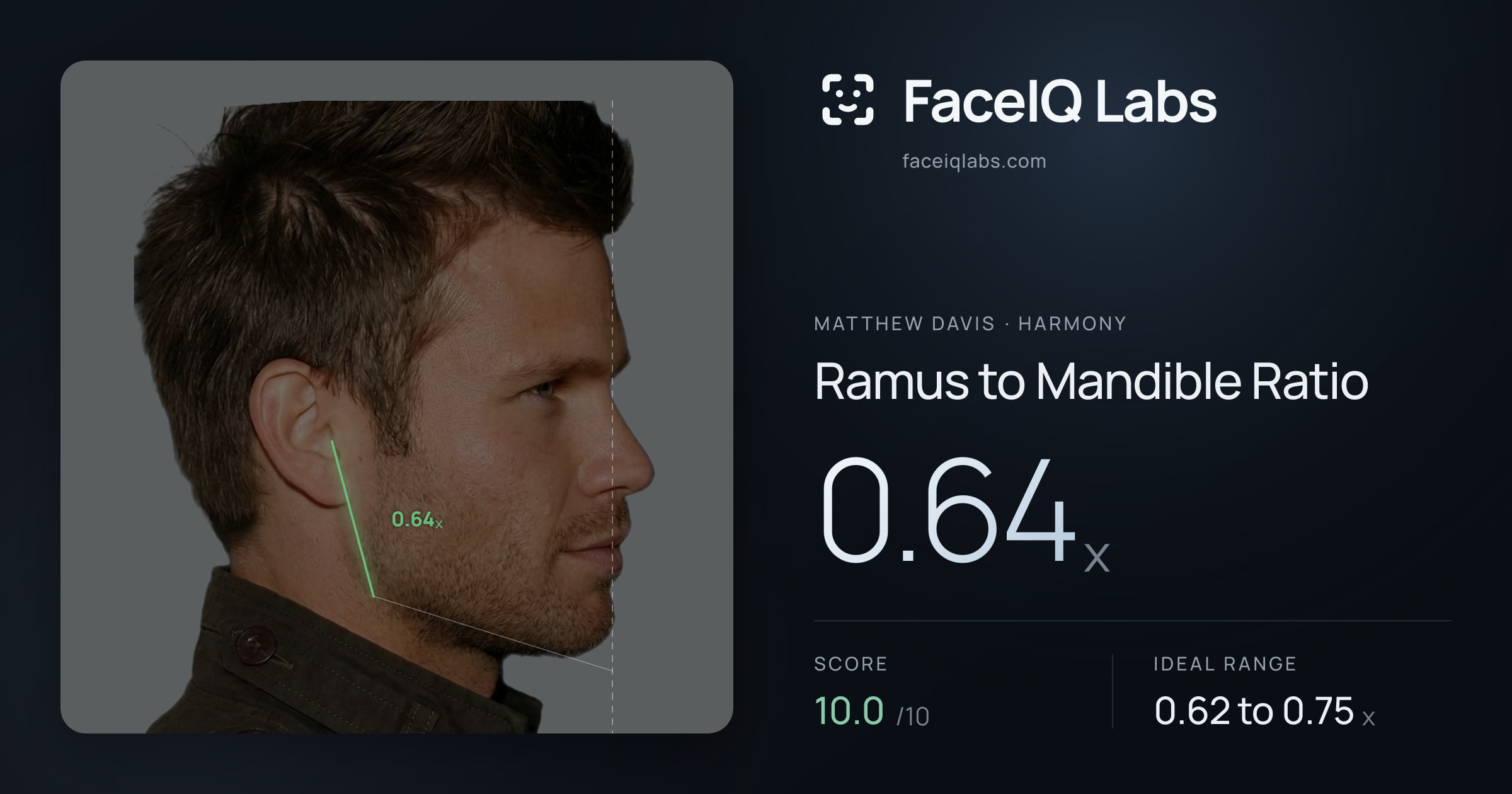 Matthew Davis Ramus to Mandible Ratio: 0.64x, drawn on the photo