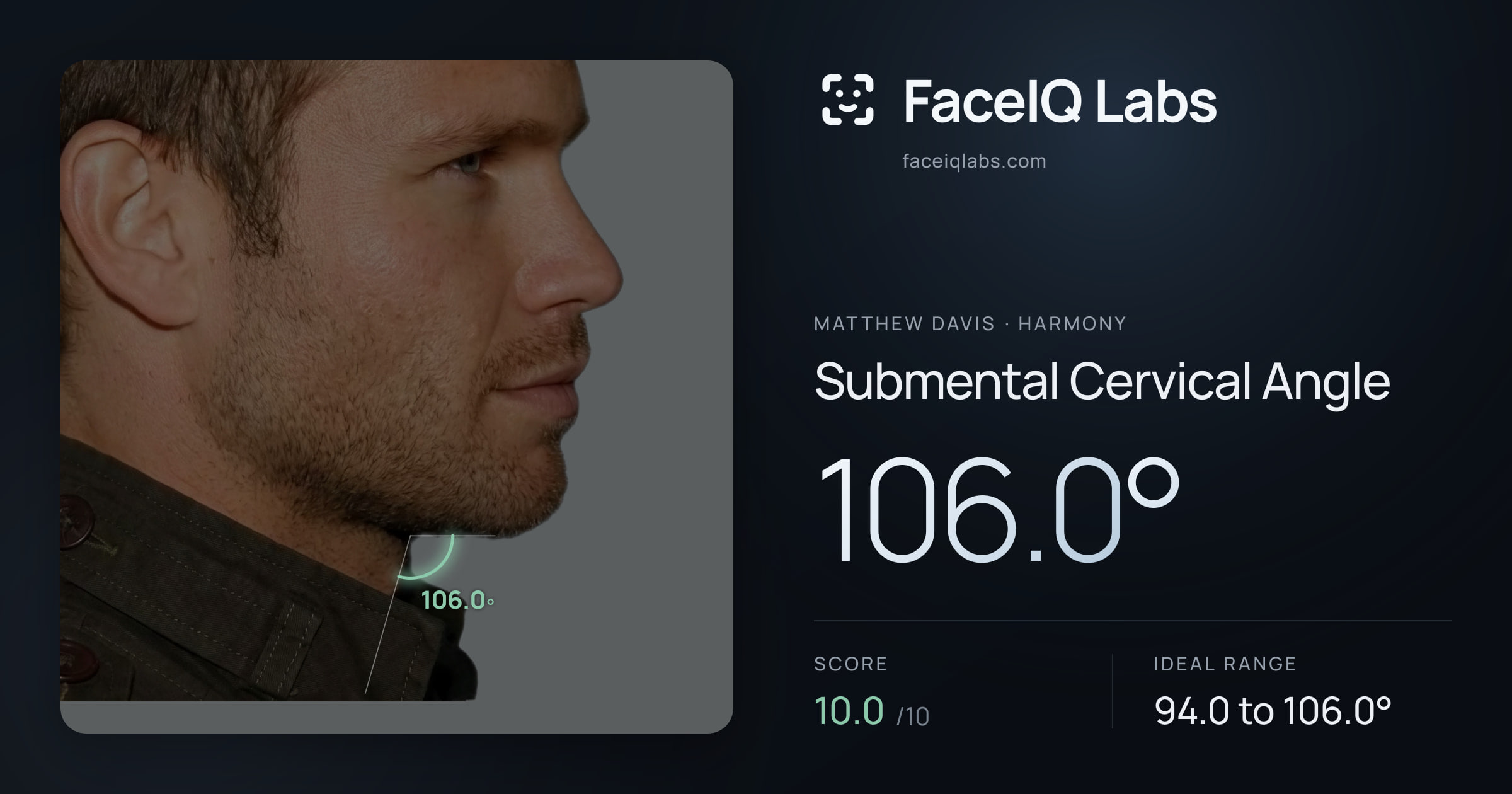Matthew Davis Submental Cervical Angle: 106.0°, drawn on the photo