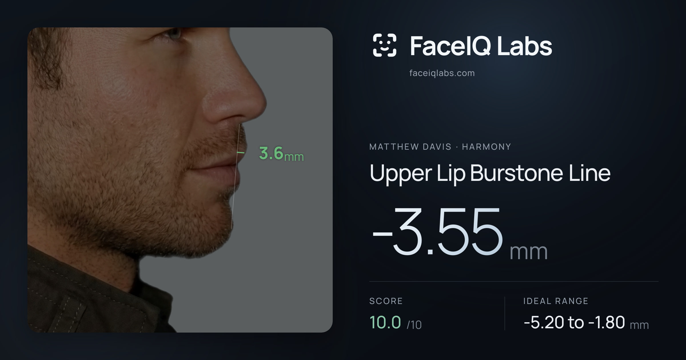 Matthew Davis Upper Lip Burstone Line: -3.55mm, drawn on the photo