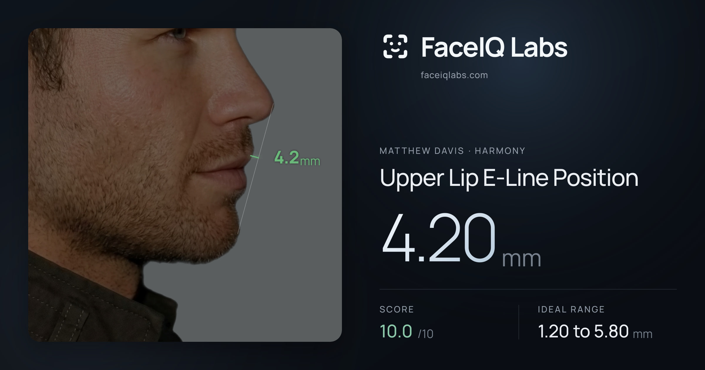 Matthew Davis Upper Lip E-Line Position: 4.20mm, drawn on the photo