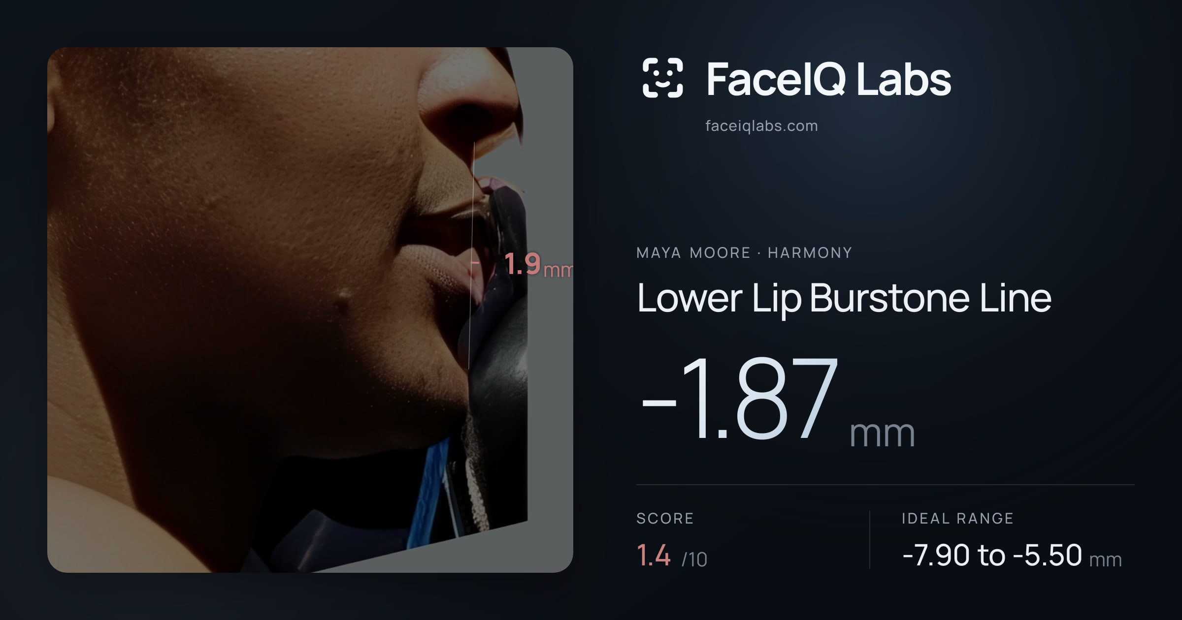 Maya Moore Lower Lip Burstone Line: -1.87mm, drawn on the photo