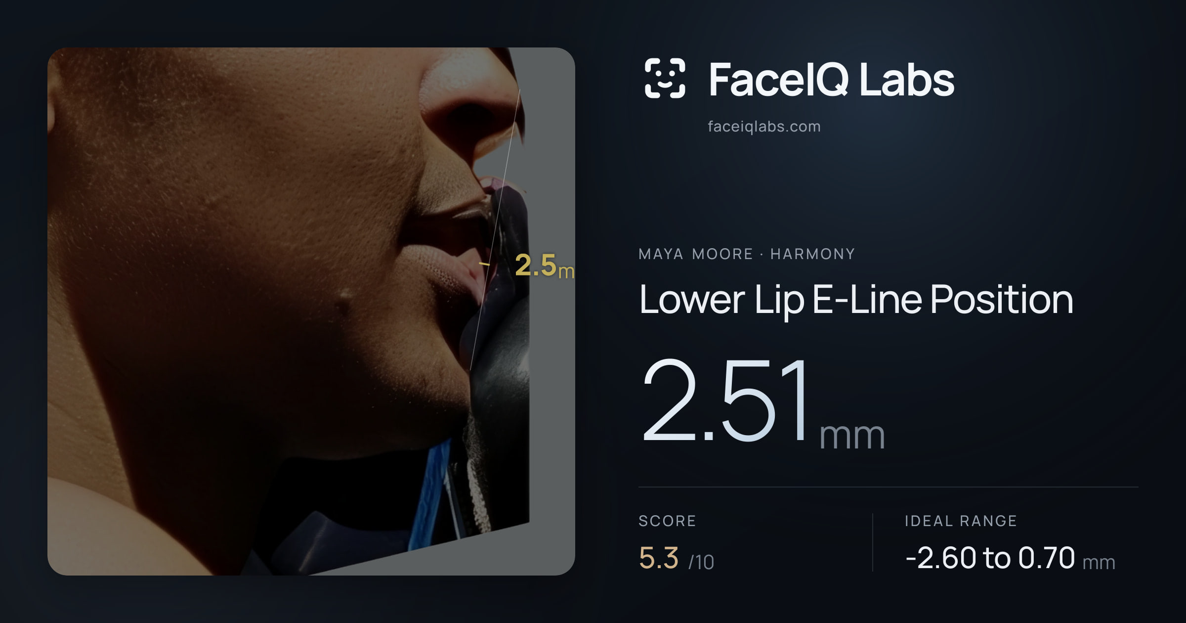 Maya Moore Lower Lip E-Line Position: 2.51mm, drawn on the photo