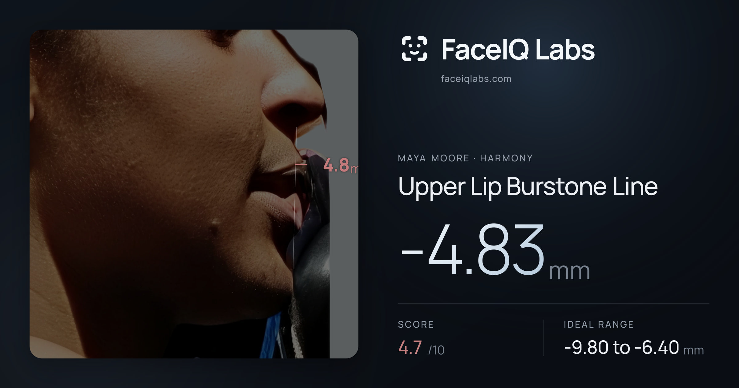 Maya Moore Upper Lip Burstone Line: -4.83mm, drawn on the photo