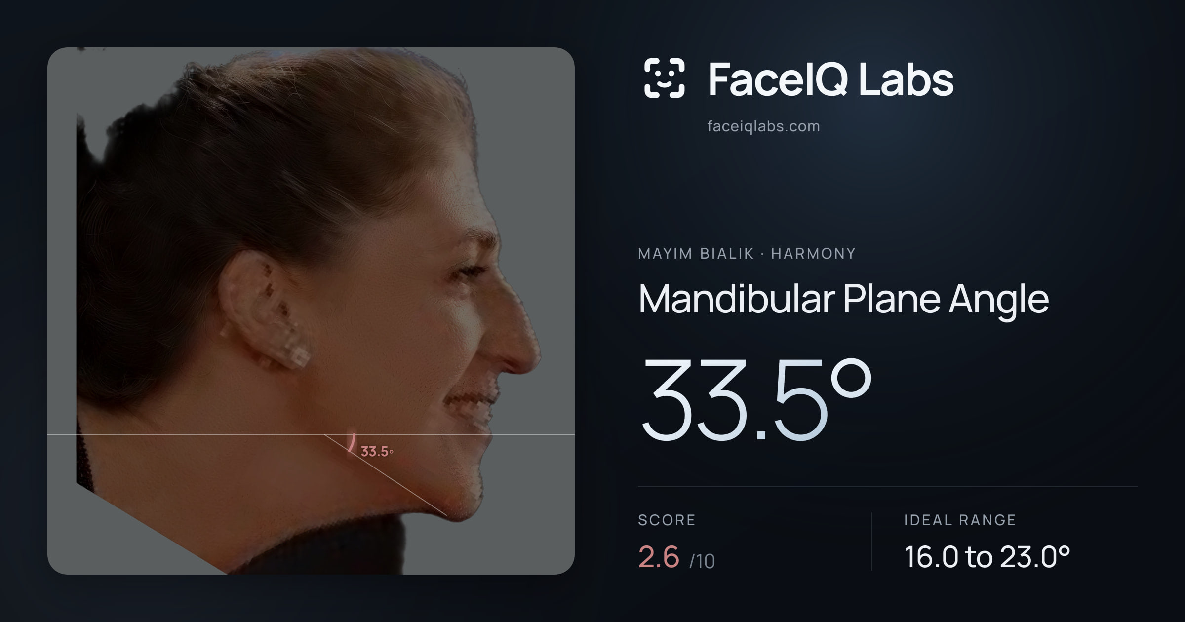 Mayim Bialik Mandibular Plane Angle: 33.5°, drawn on the photo