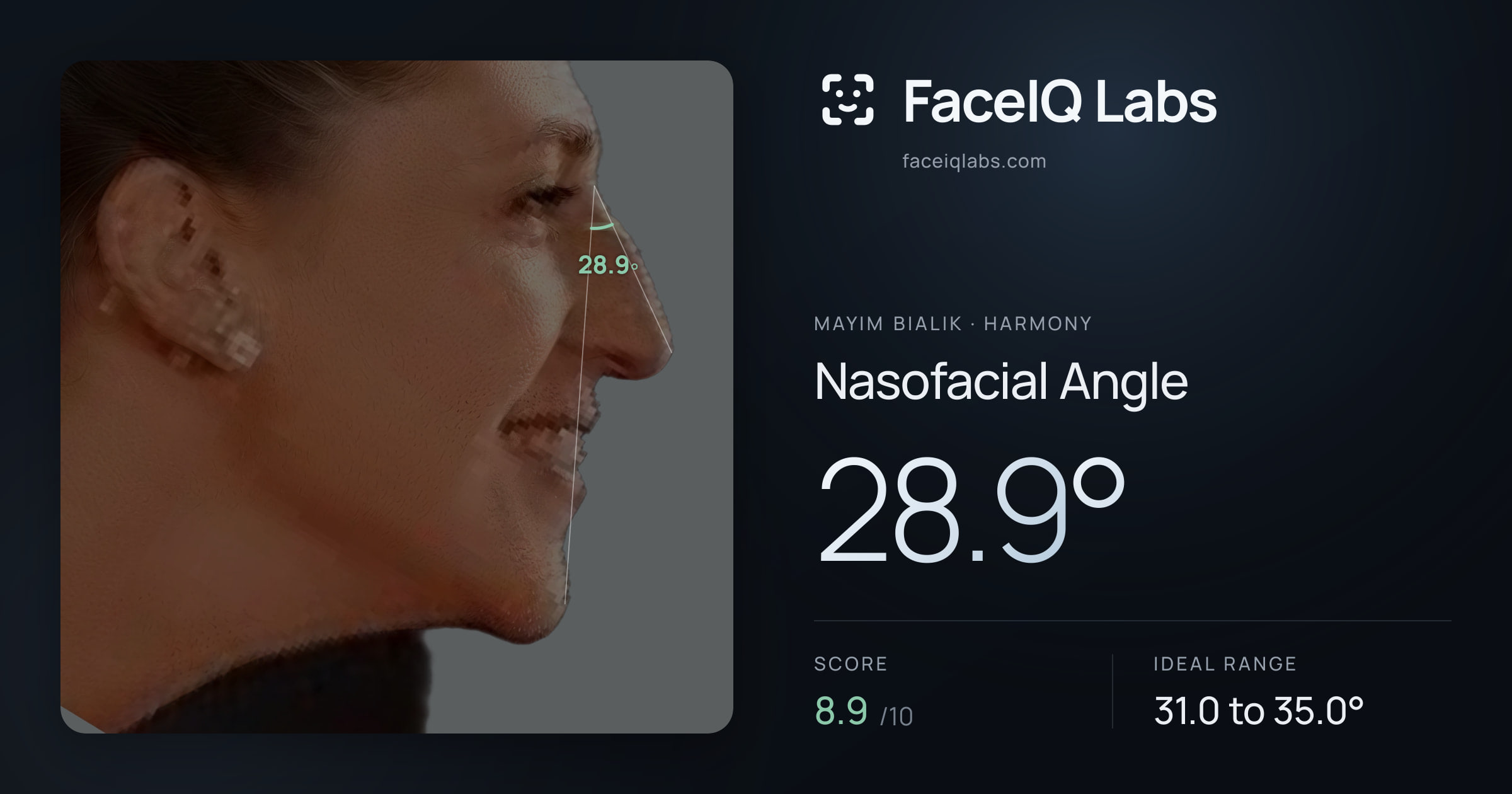 Mayim Bialik Nasofacial Angle: 28.9°, drawn on the photo