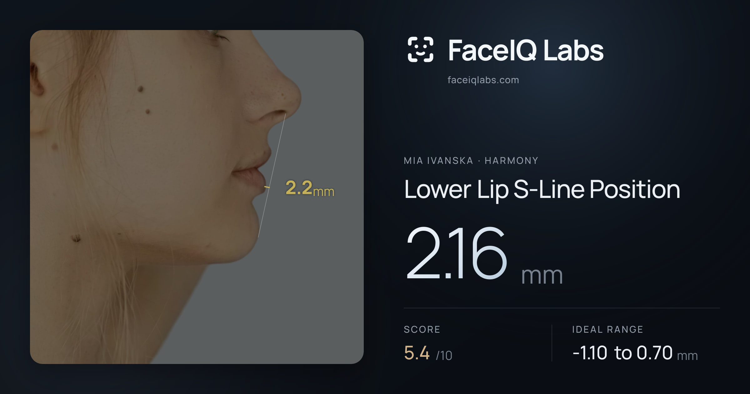 Mia Ivanska Lower Lip S-Line Position: 2.16mm, drawn on the photo