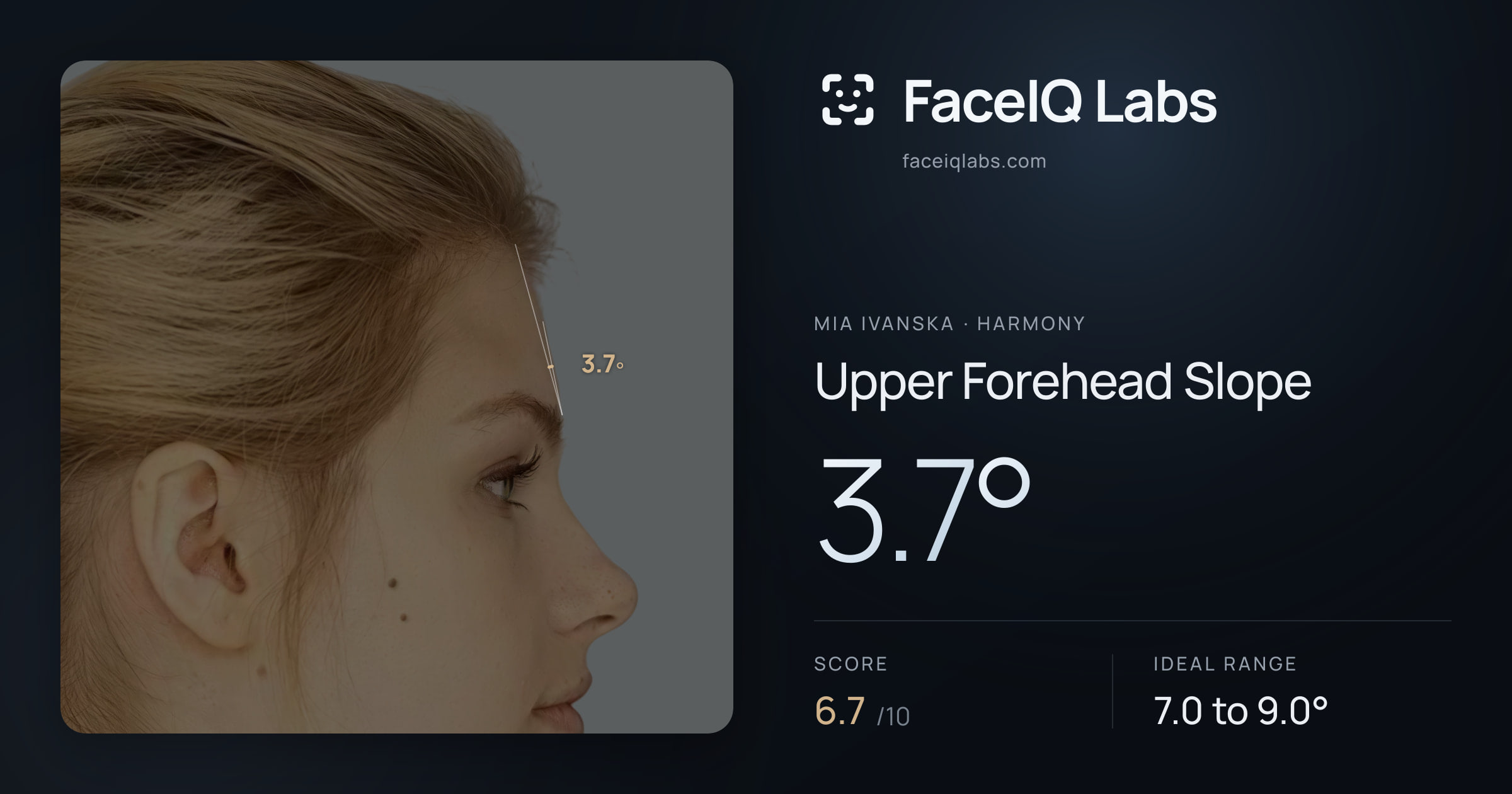 Mia Ivanska Upper Forehead Slope: 3.7°, drawn on the photo