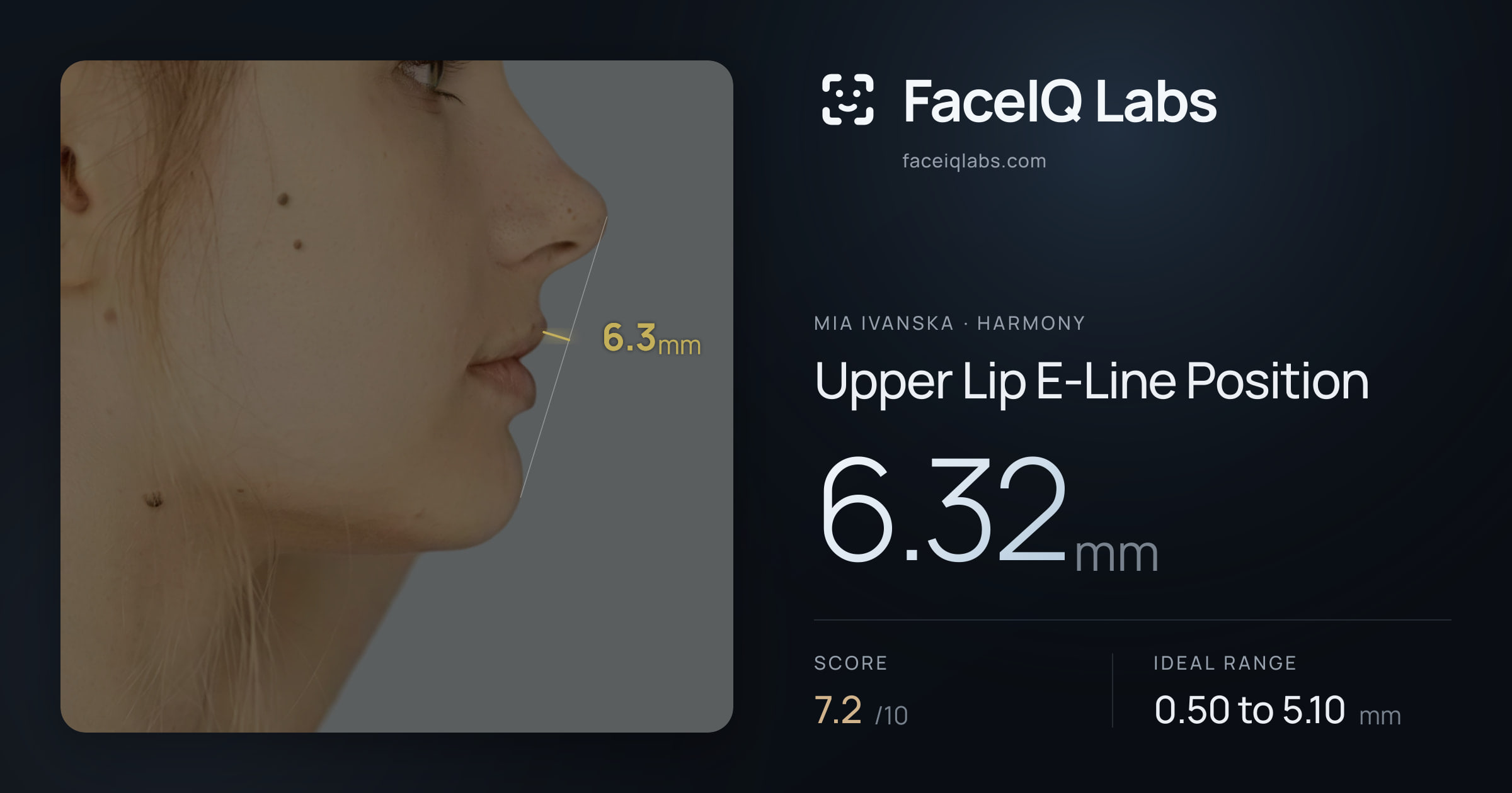 Mia Ivanska Upper Lip E-Line Position: 6.32mm, drawn on the photo