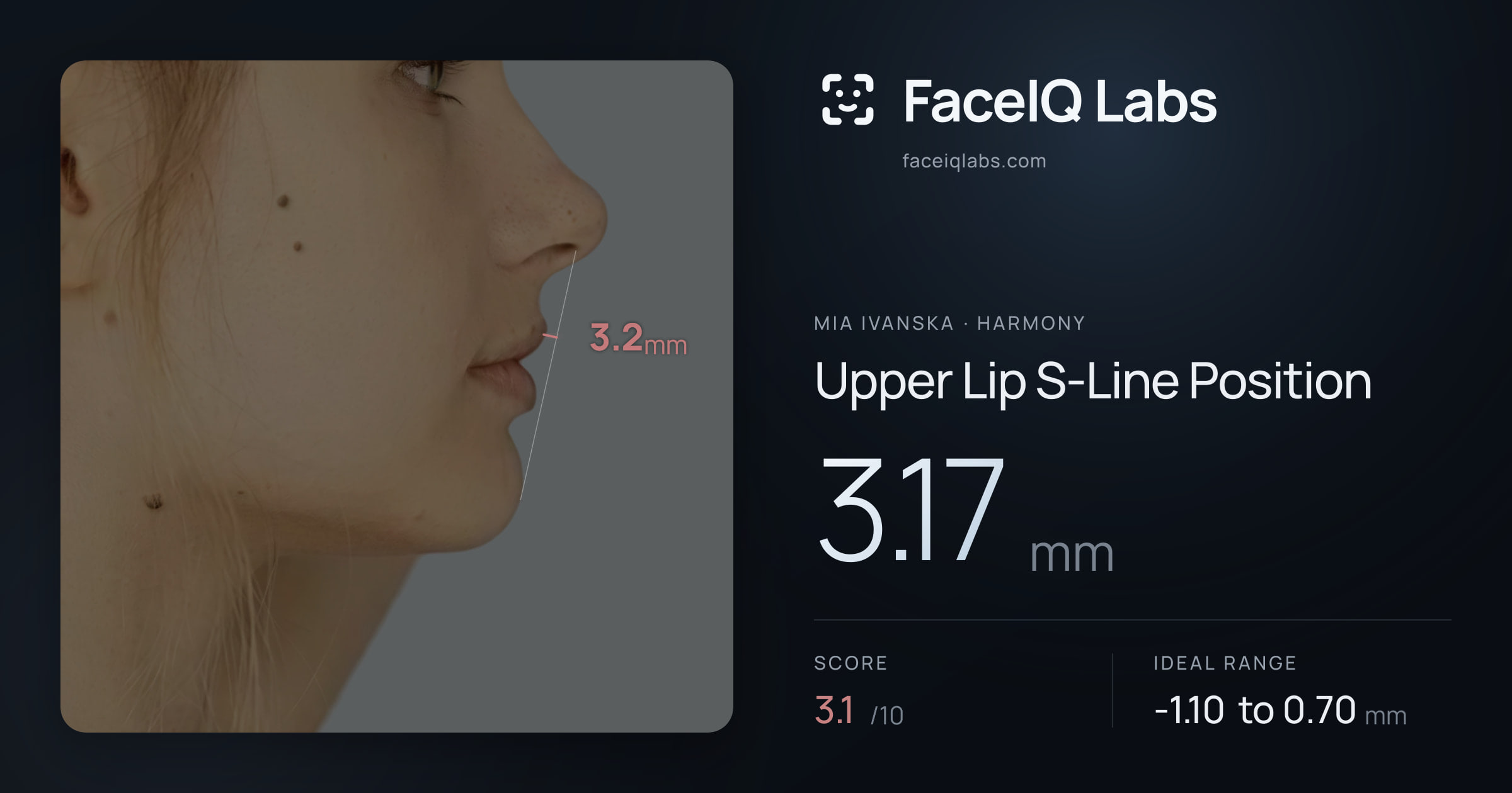Mia Ivanska Upper Lip S-Line Position: 3.17mm, drawn on the photo