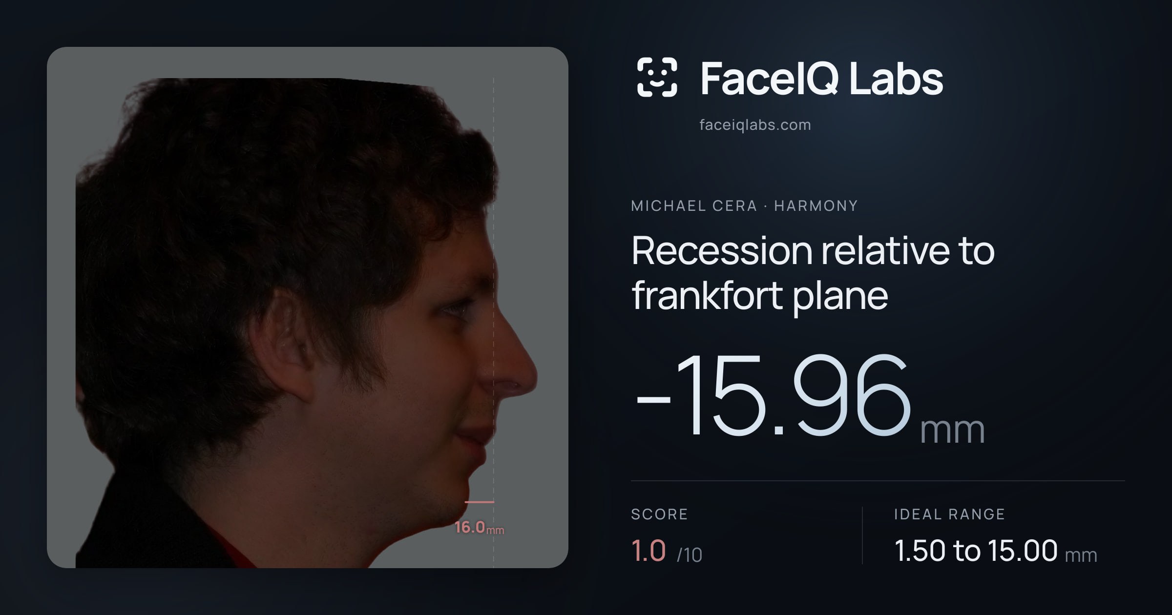 Michael Cera Recession relative to frankfort plane: -15.96mm, drawn on the photo
