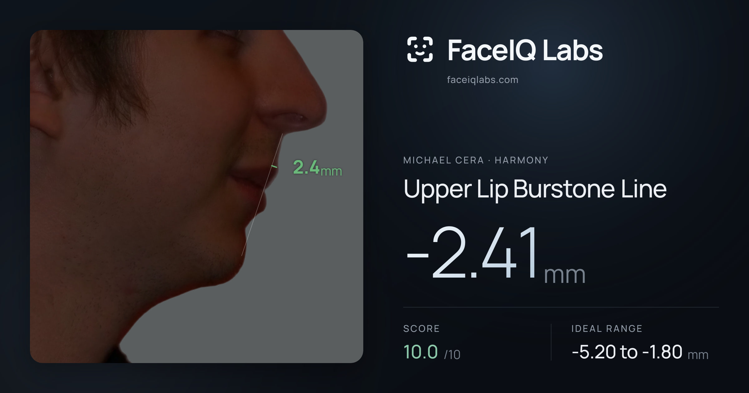 Michael Cera Upper Lip Burstone Line: -2.41mm, drawn on the photo