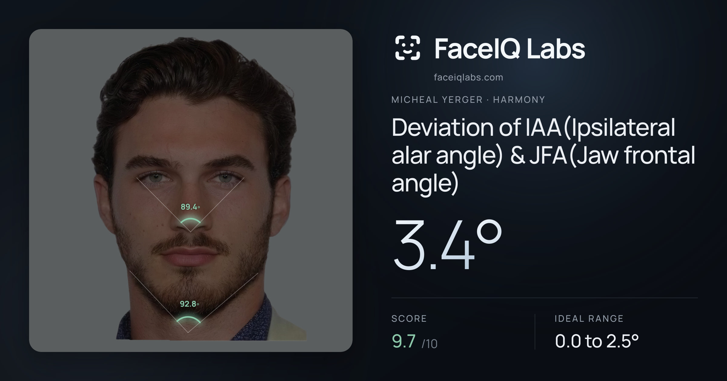 Micheal Yerger Deviation of IAA(Ipsilateral alar angle) & JFA(Jaw frontal angle): 3.4°, drawn on the photo