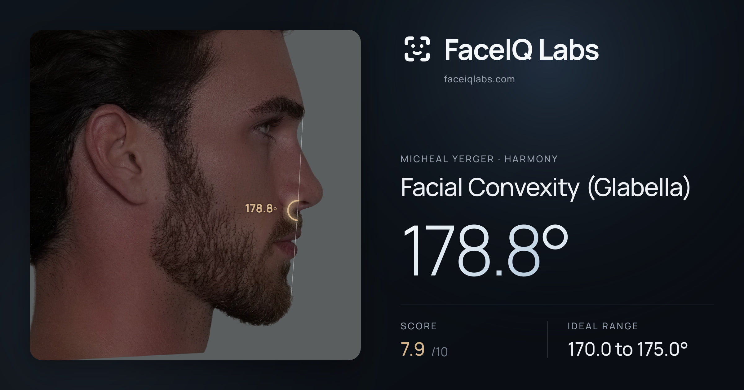 Micheal Yerger Facial Convexity (Glabella): 178.8°, drawn on the photo