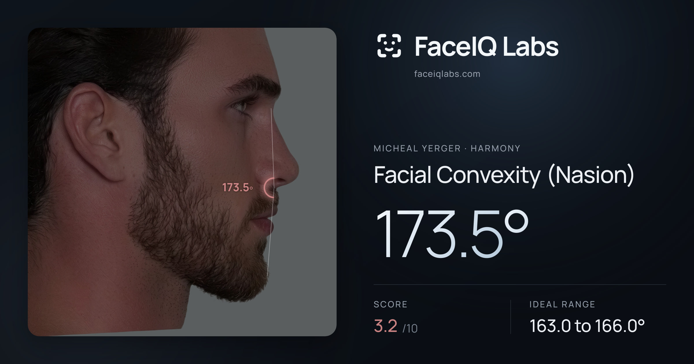 Micheal Yerger Facial Convexity (Nasion): 173.5°, drawn on the photo