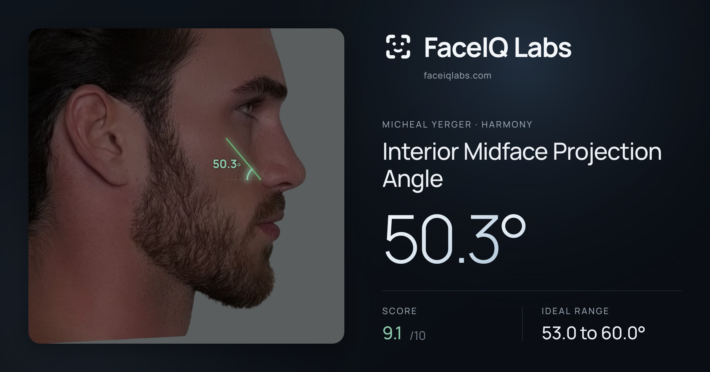 Micheal Yerger Interior Midface Projection Angle: 50.3°, drawn on the photo