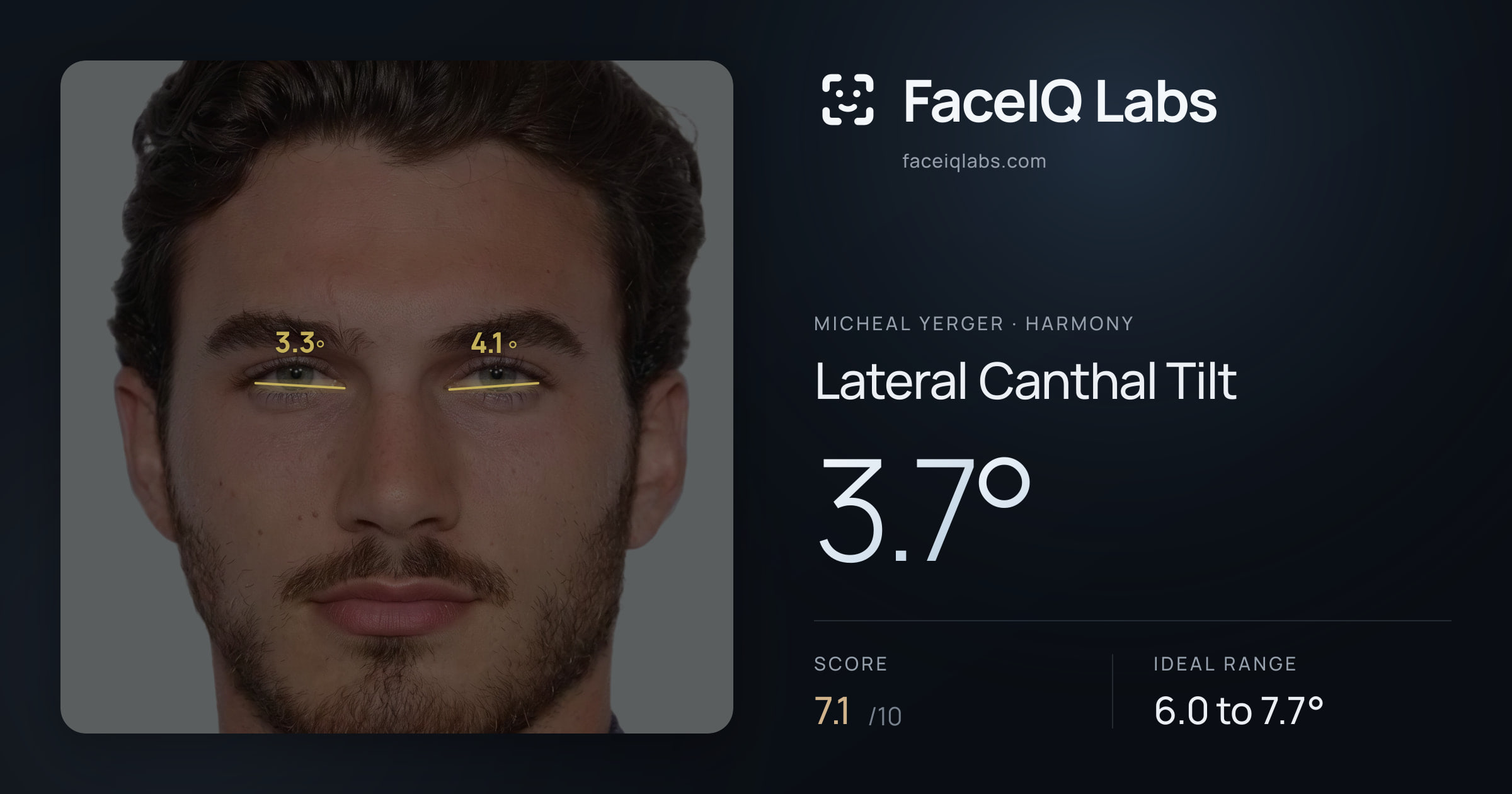 Micheal Yerger Lateral Canthal Tilt: 3.7°, drawn on the photo