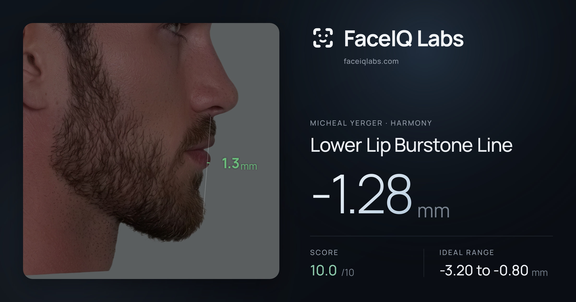Micheal Yerger Lower Lip Burstone Line: -1.28mm, drawn on the photo