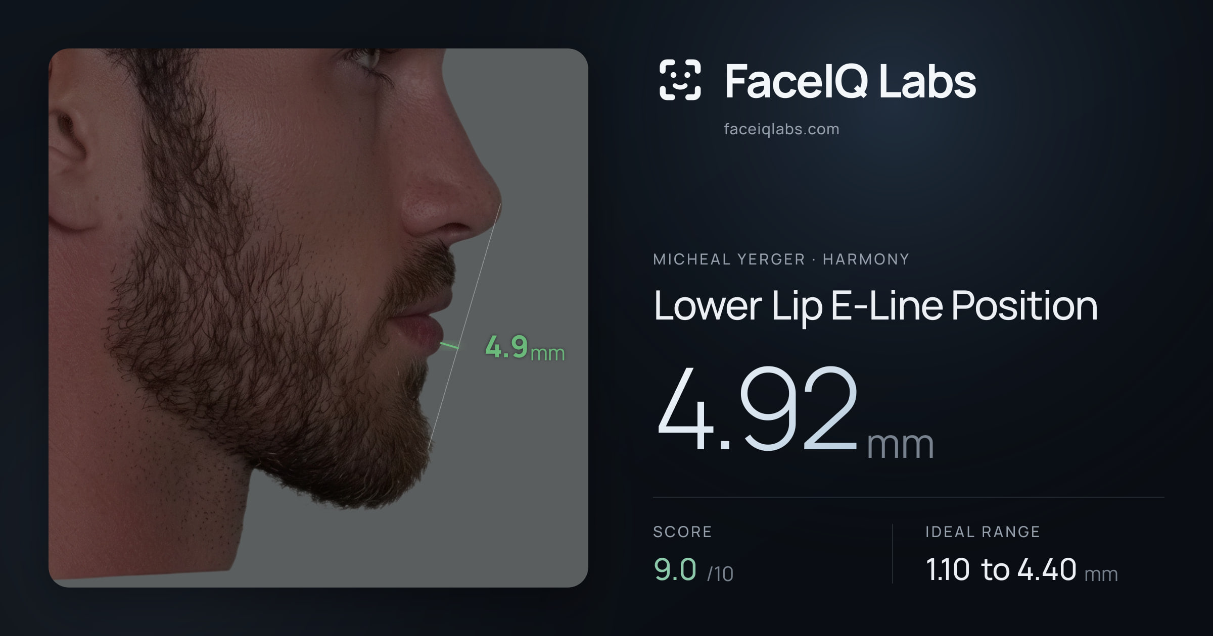 Micheal Yerger Lower Lip E-Line Position: 4.92mm, drawn on the photo