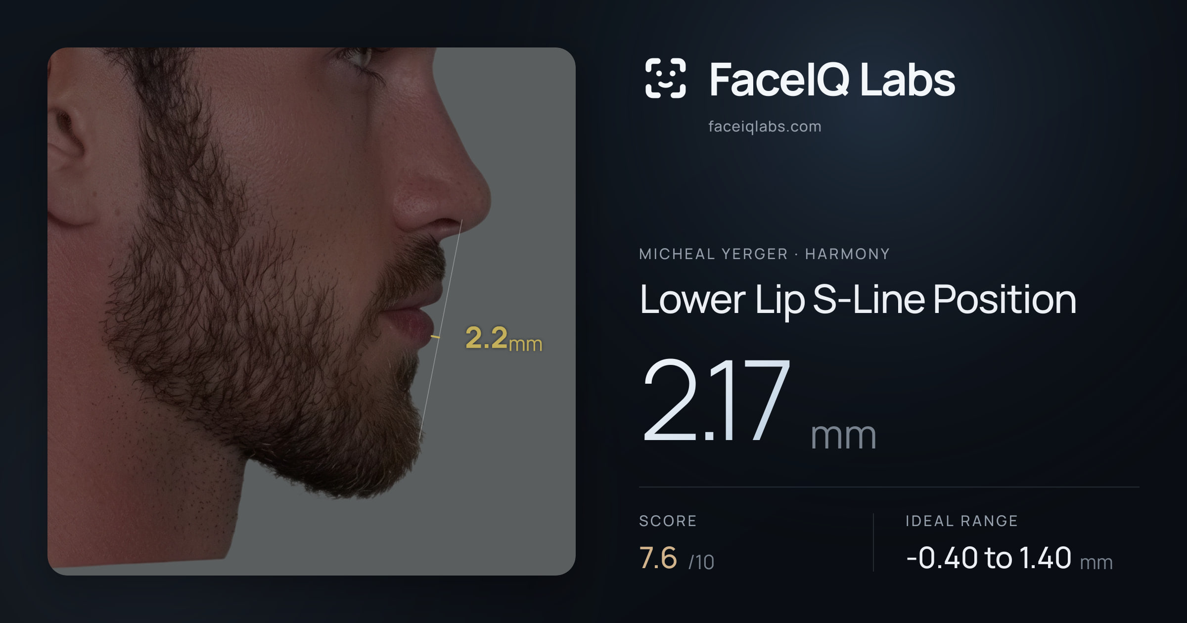 Micheal Yerger Lower Lip S-Line Position: 2.17mm, drawn on the photo