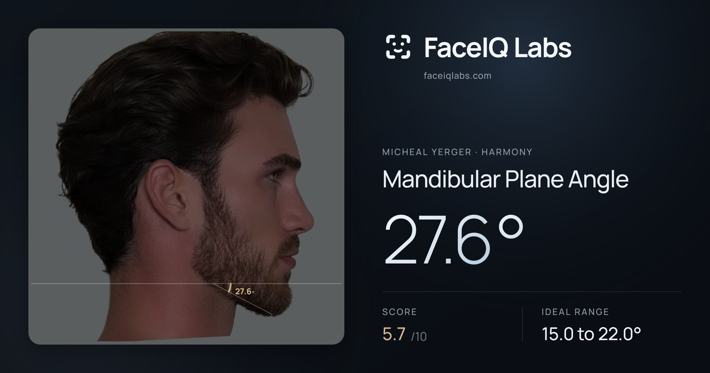 Micheal Yerger Mandibular Plane Angle: 27.6°, drawn on the photo