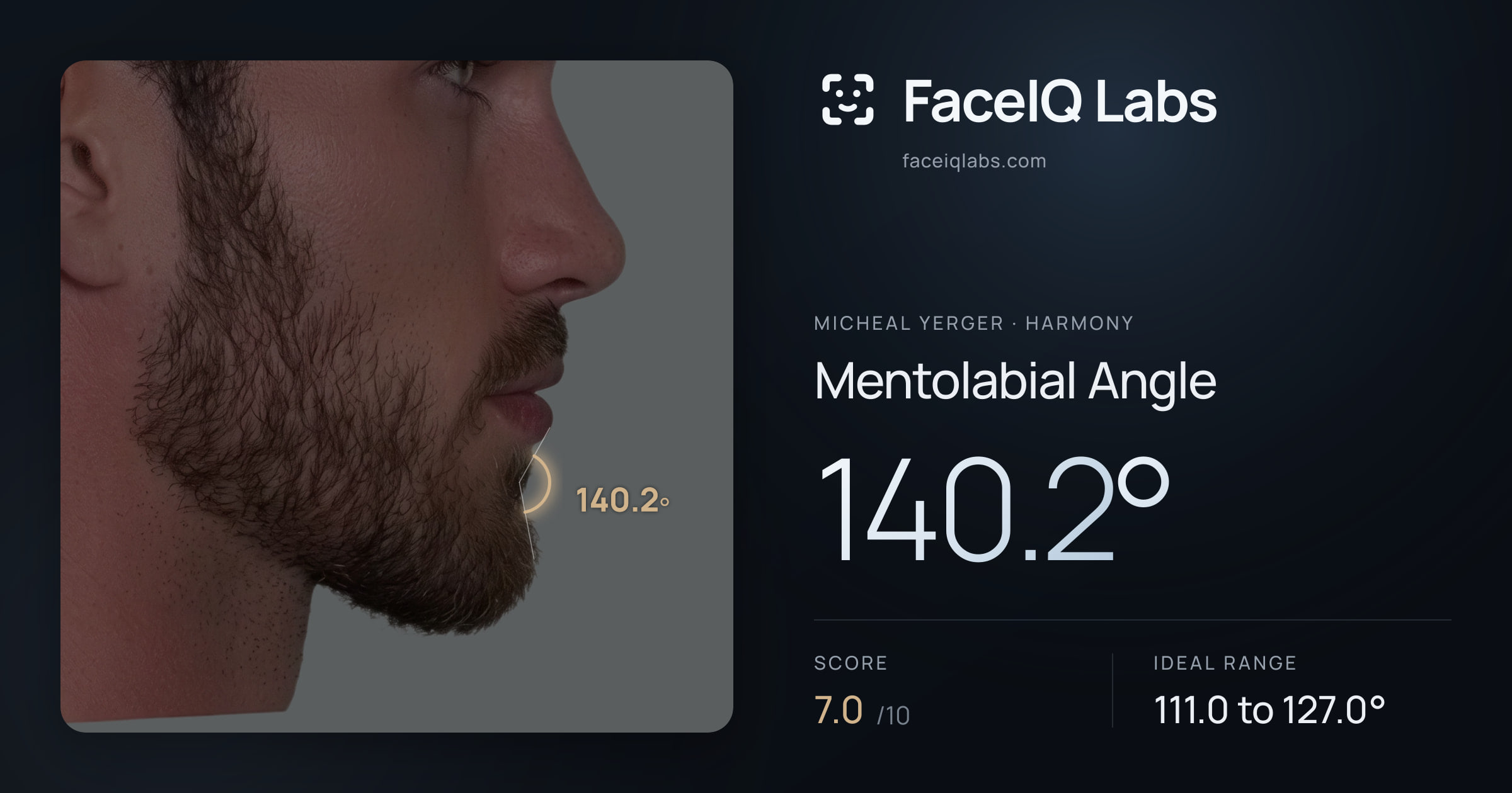 Micheal Yerger Mentolabial Angle: 140.2°, drawn on the photo