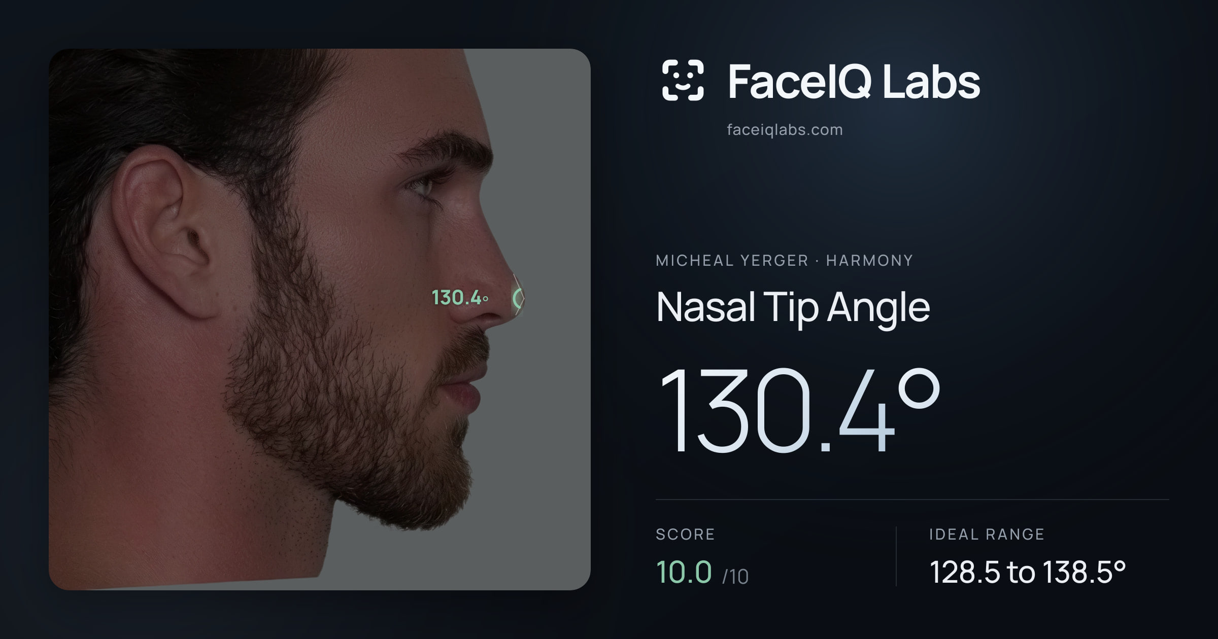 Micheal Yerger Nasal Tip Angle: 130.4°, drawn on the photo