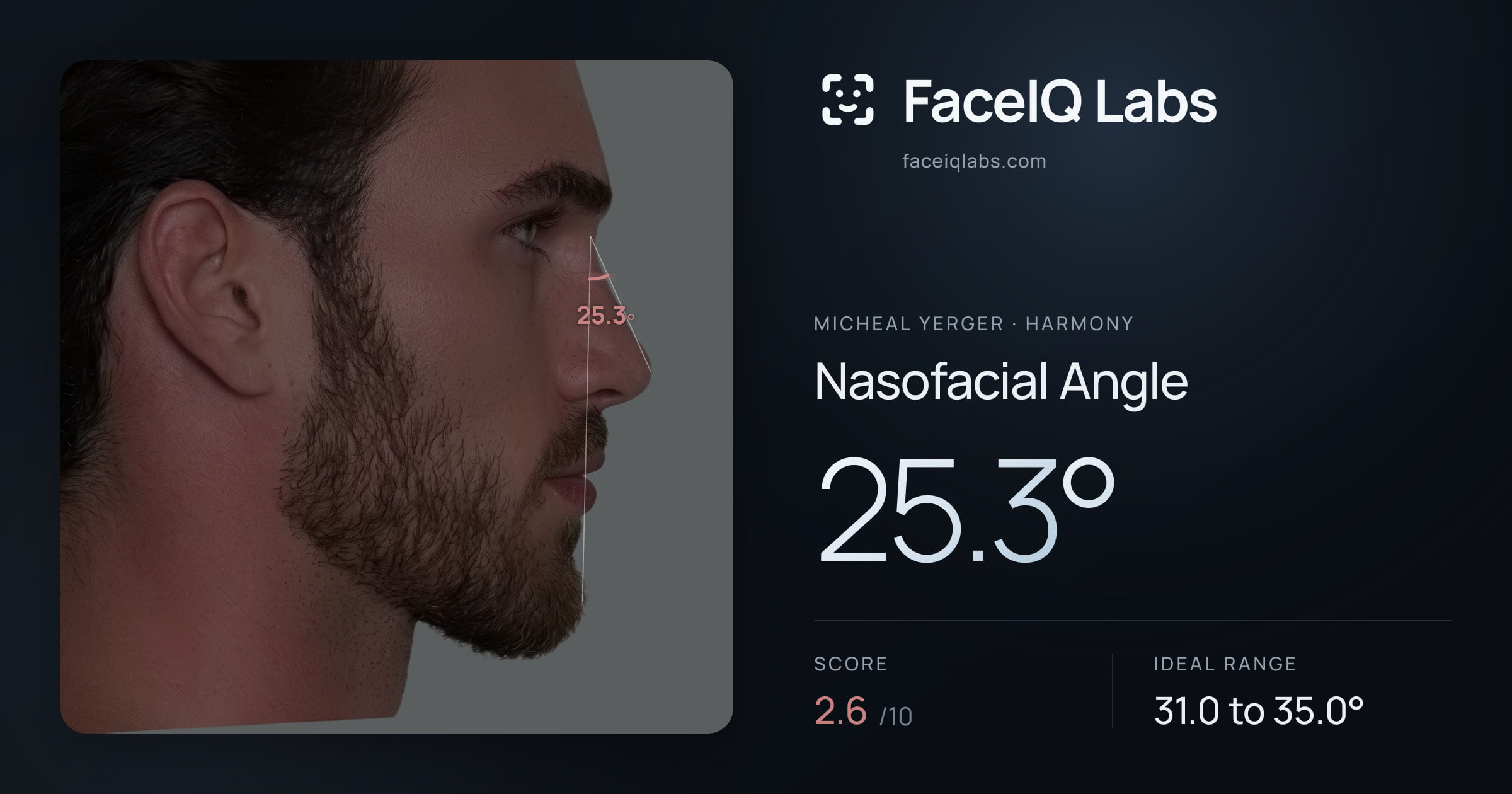 Micheal Yerger Nasofacial Angle: 25.3°, drawn on the photo