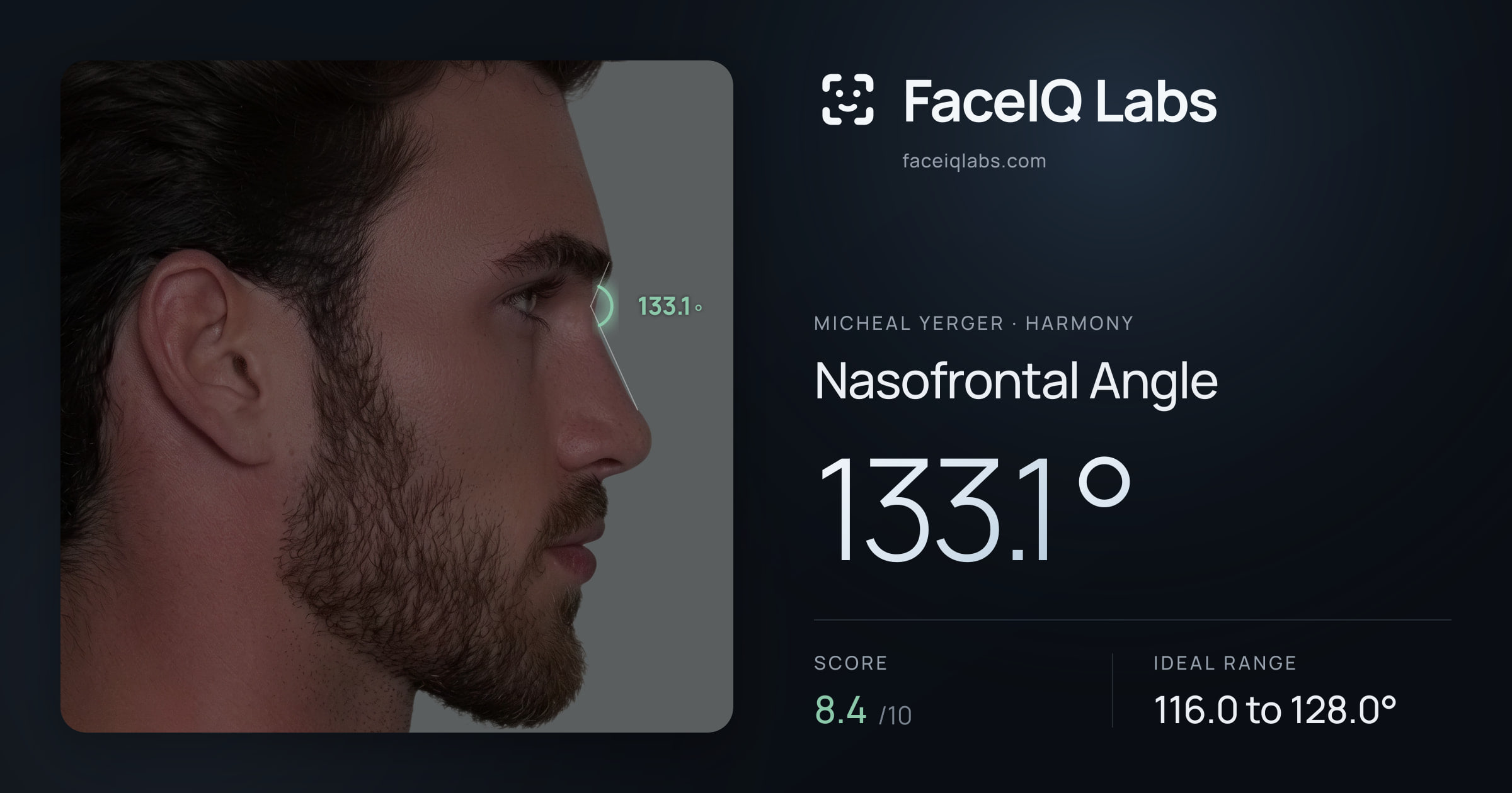 Micheal Yerger Nasofrontal Angle: 133.1°, drawn on the photo