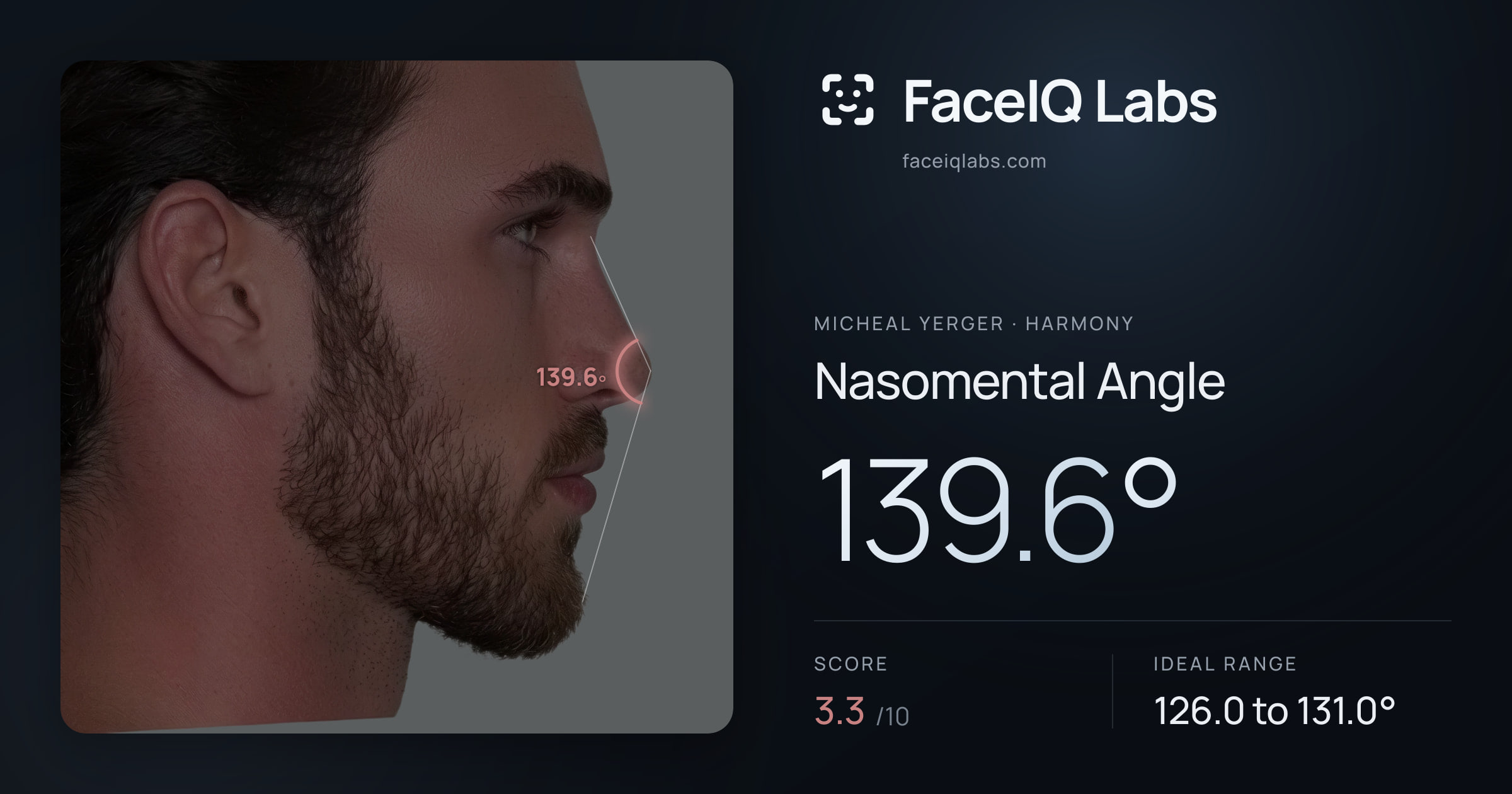 Micheal Yerger Nasomental Angle: 139.6°, drawn on the photo