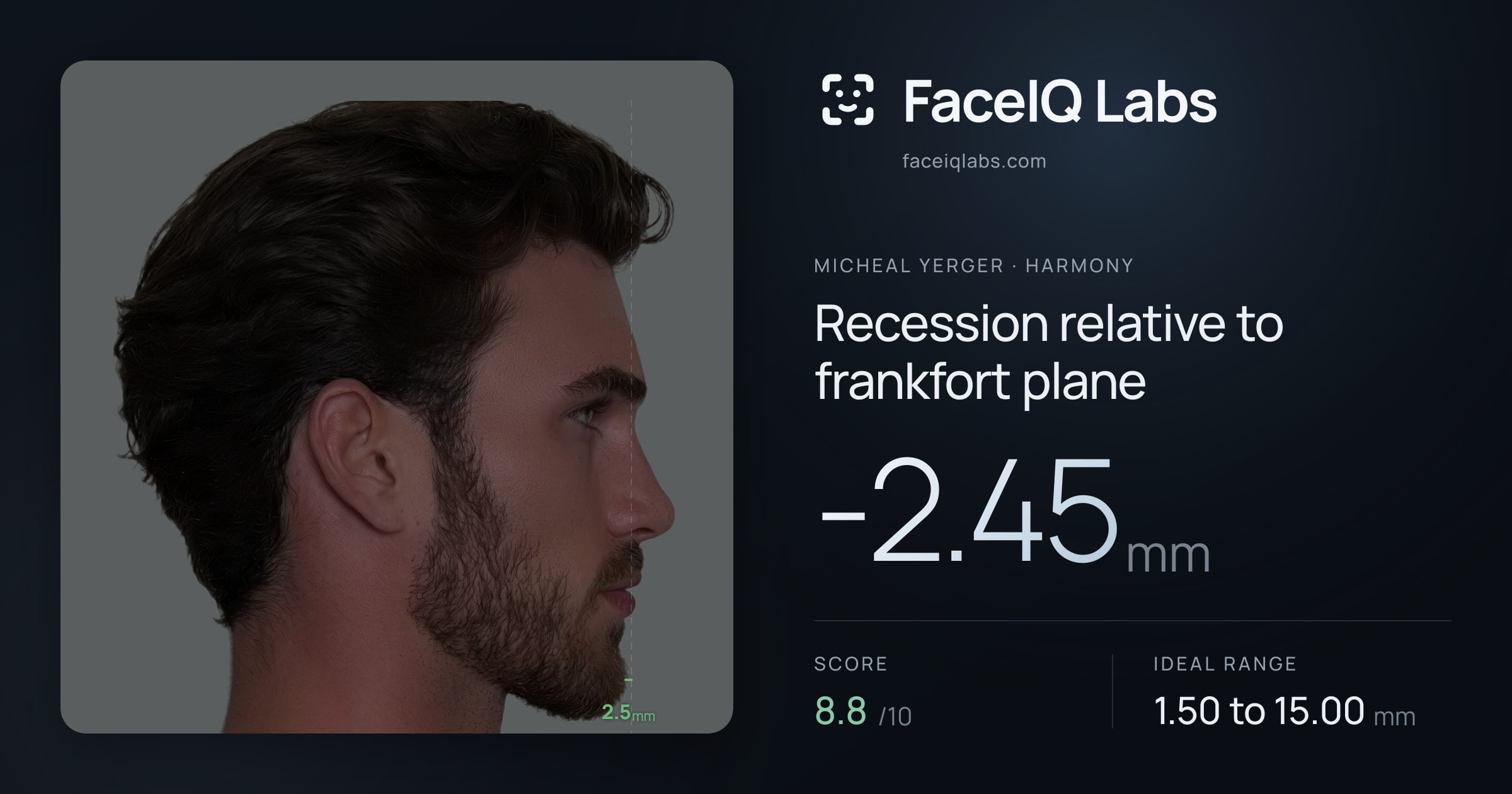Micheal Yerger Recession relative to frankfort plane: -2.45mm, drawn on the photo