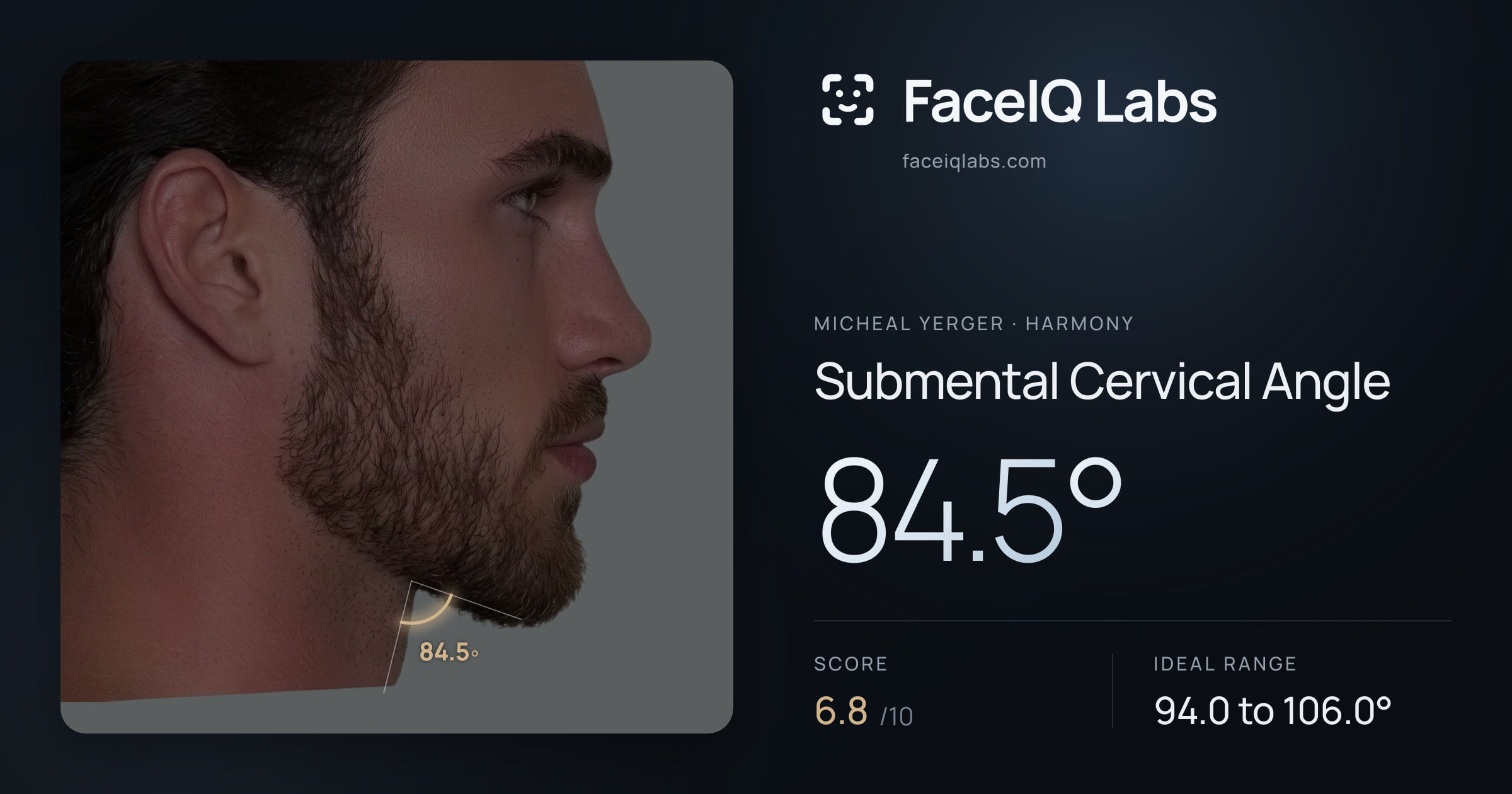 Micheal Yerger Submental Cervical Angle: 84.5°, drawn on the photo